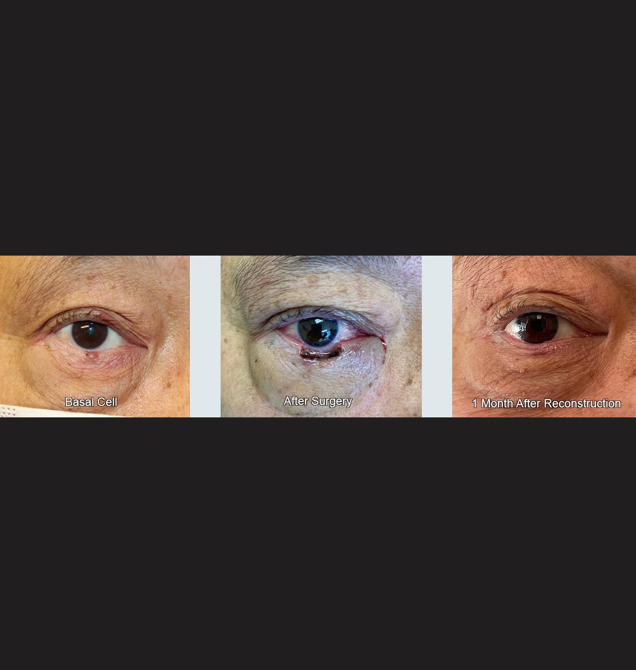 Eyelid Reconstruction