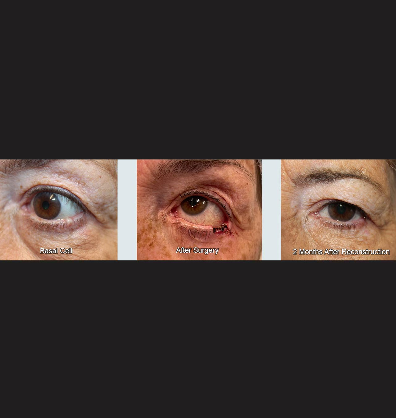 Eyelid Reconstruction