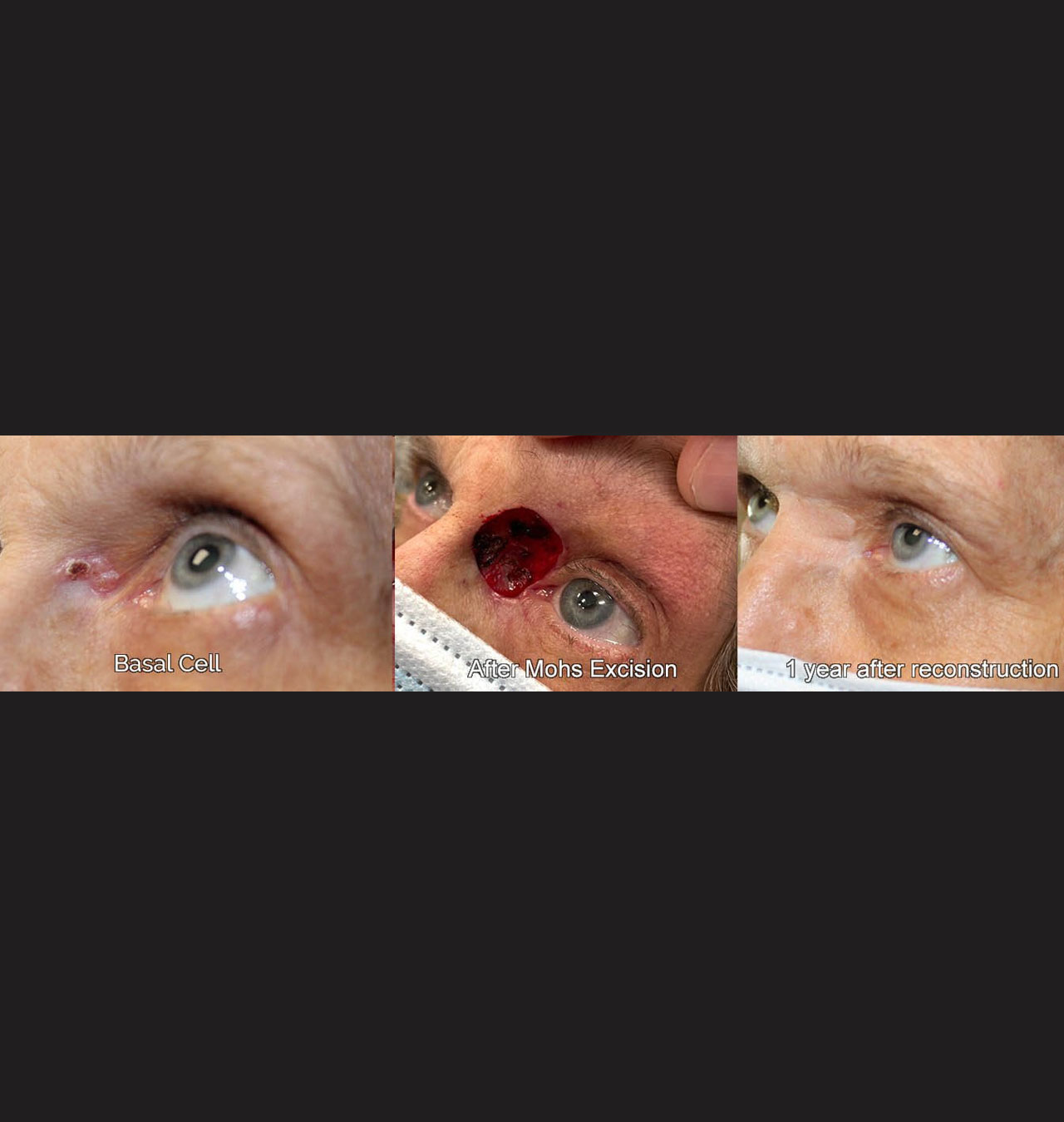 Eyelid Reconstruction After Skin Cancer