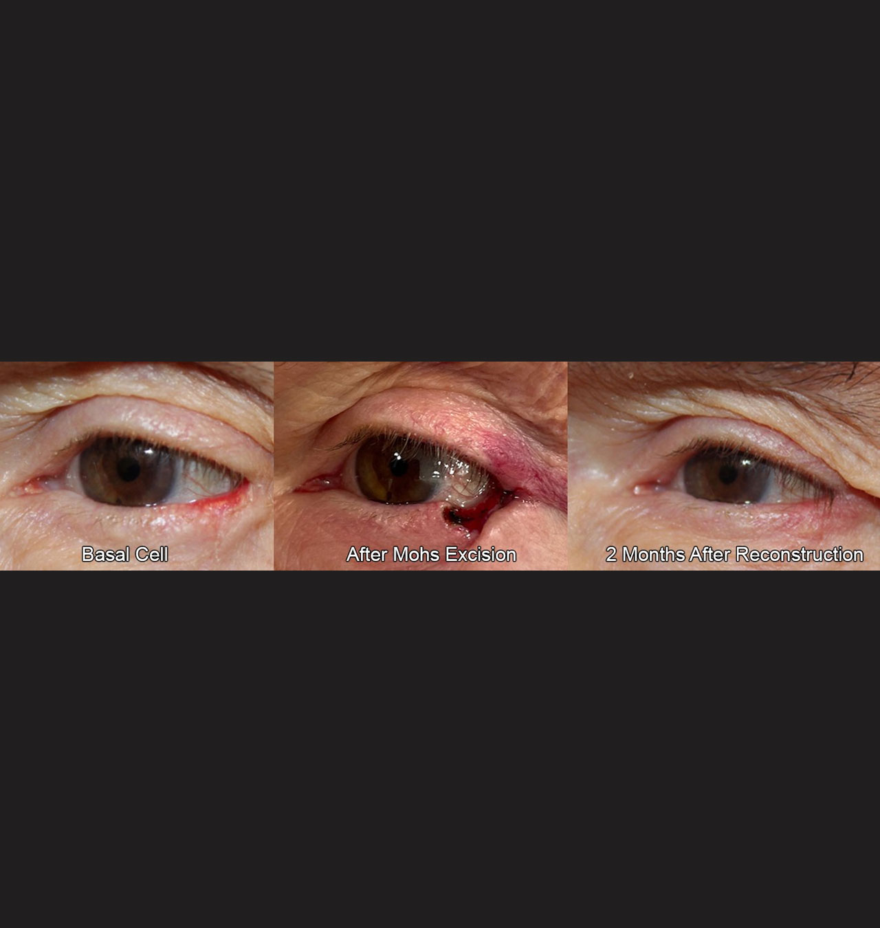 Eyelid Reconstruction After Skin Cancer