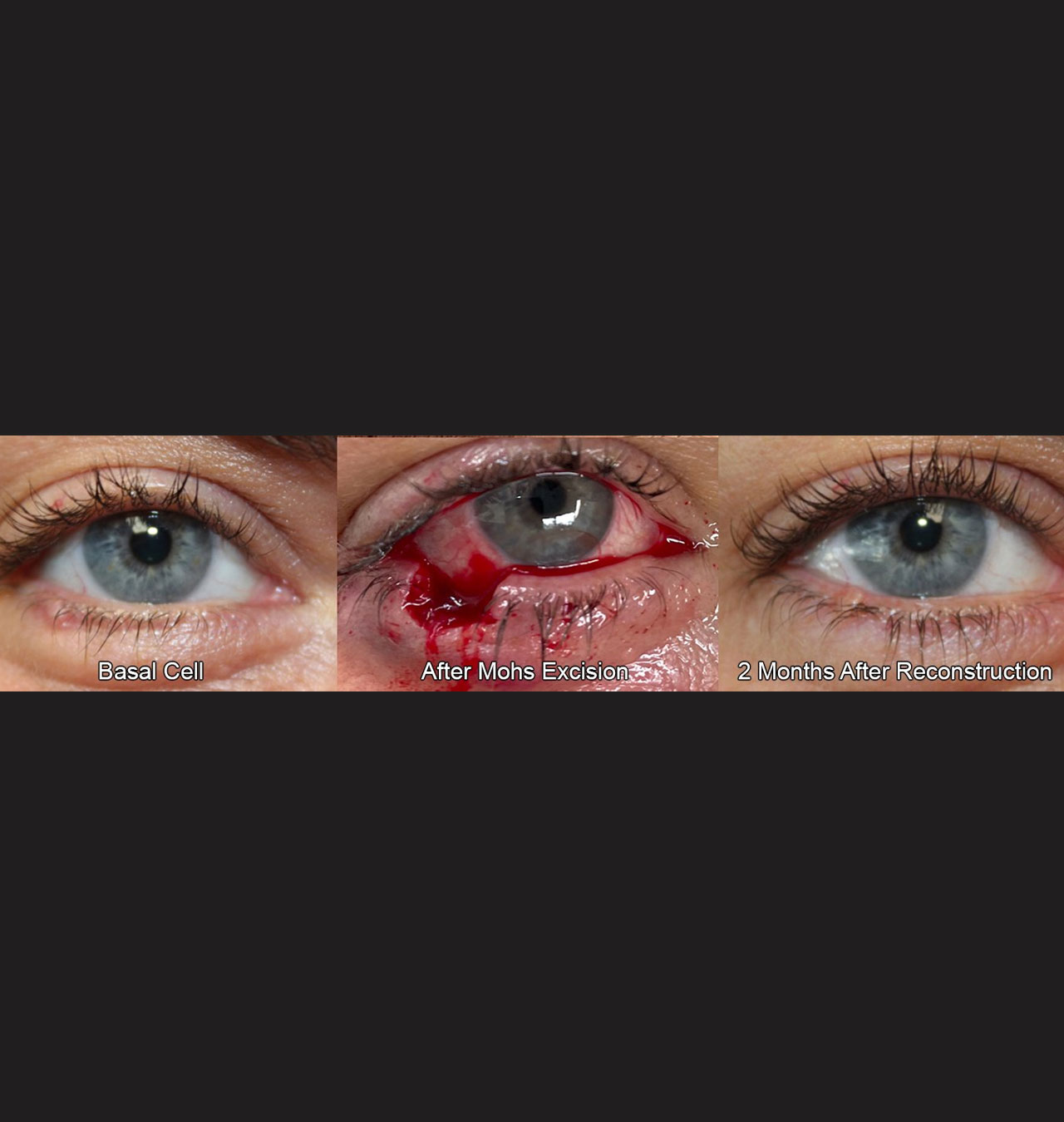 Eyelid Reconstruction After Skin Cancer