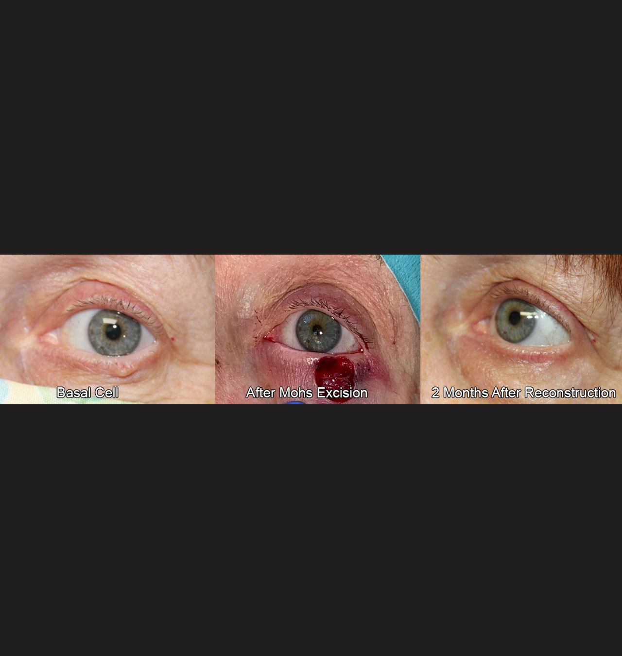 Eyelid Reconstruction After Skin Cancer