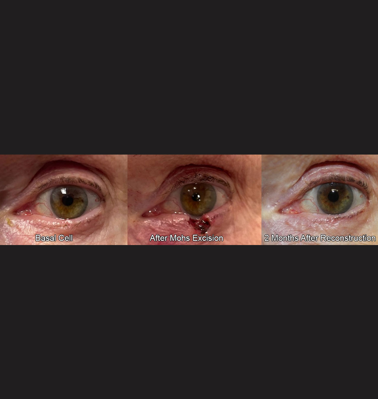 Eyelid Reconstruction After Skin Cancer