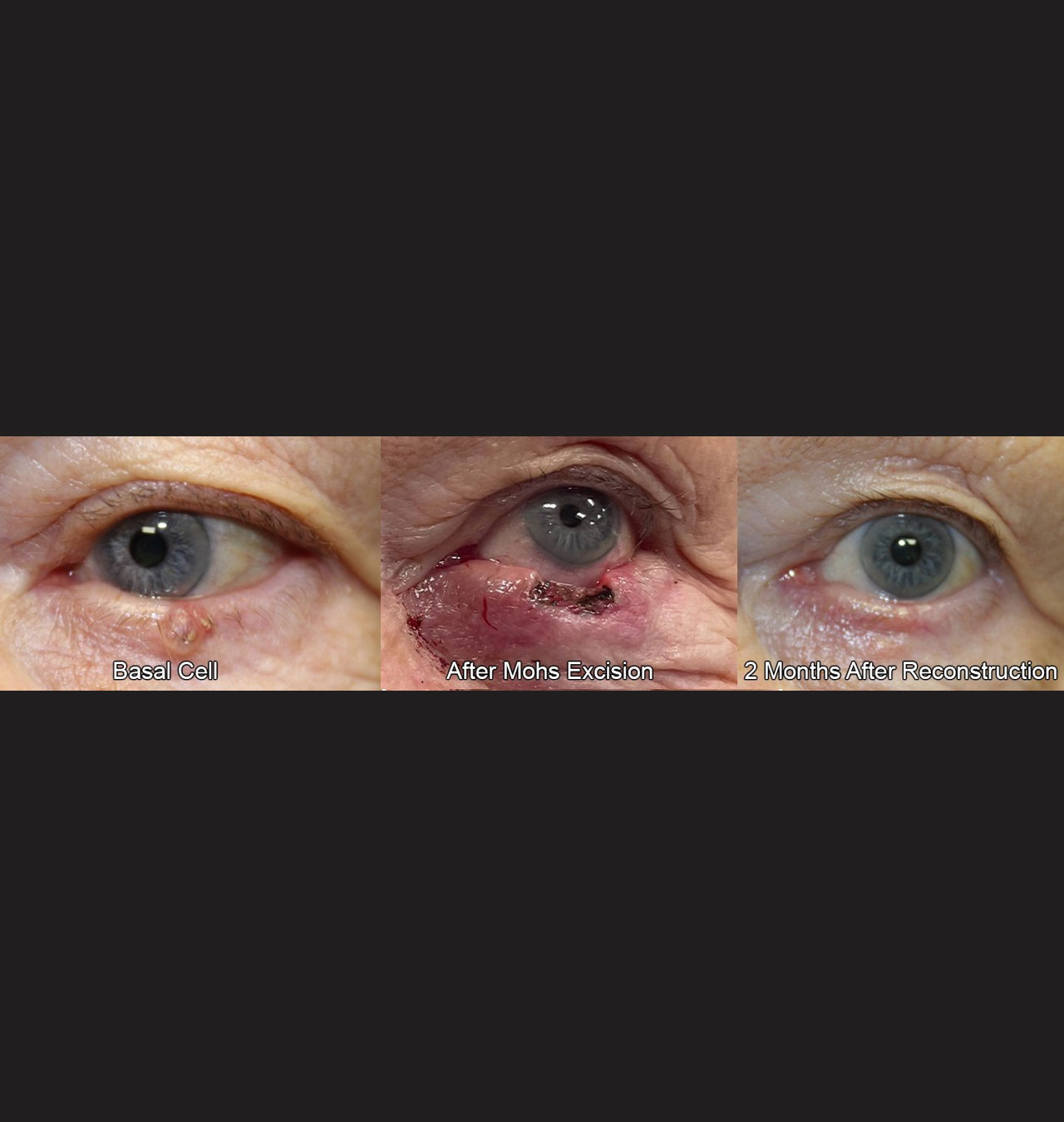 Eyelid Reconstruction After Skin Cancer