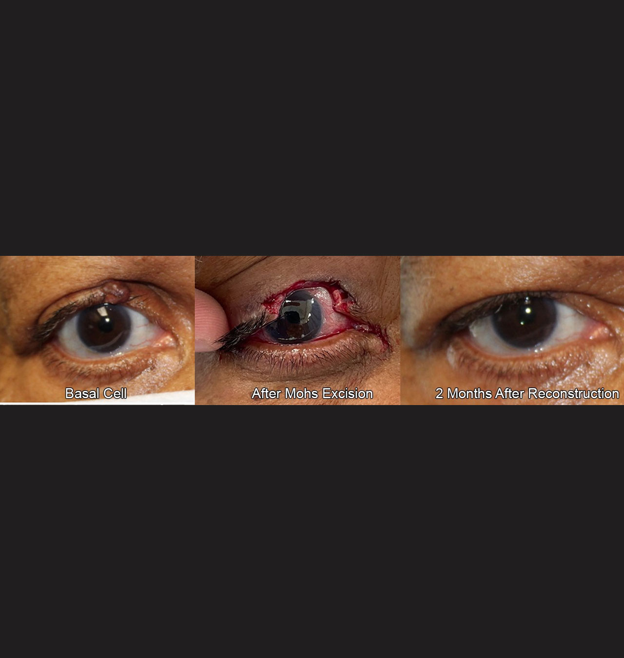 Eyelid Reconstruction After Skin Cancer