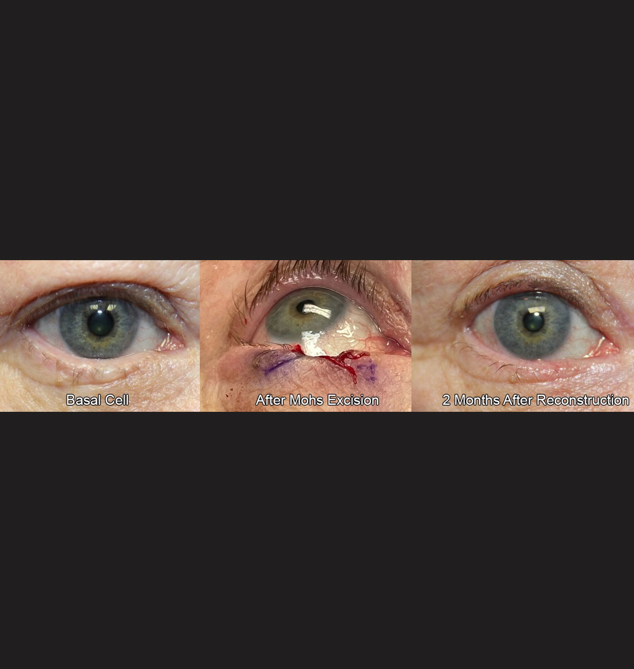 Eyelid Reconstruction After Skin Cancer