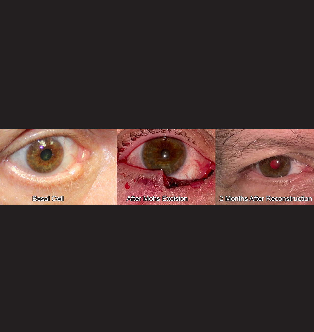 Eyelid Reconstruction After Skin Cancer
