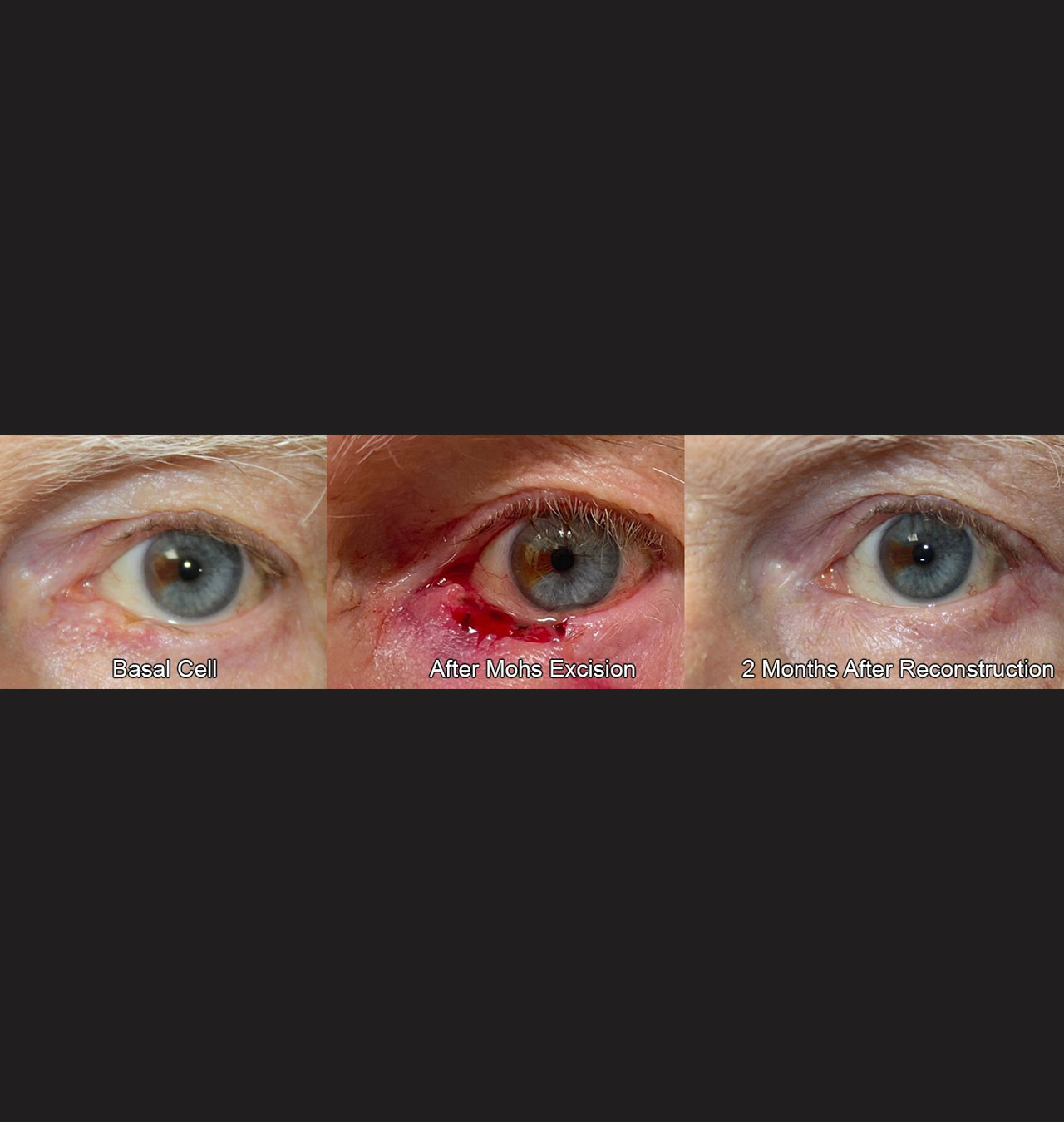 Eyelid Reconstruction After Skin Cancer