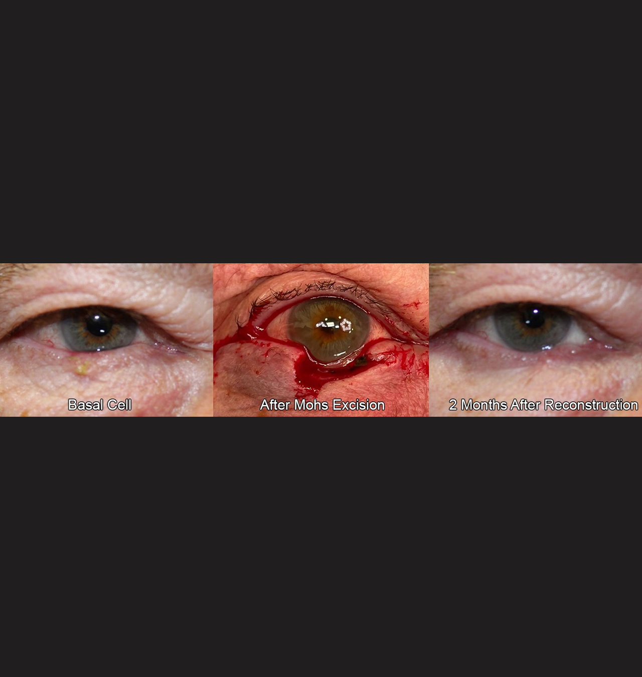 Eyelid Reconstruction After Skin Cancer