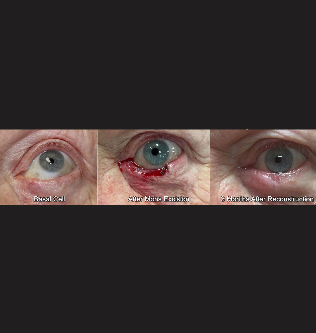 Eyelid Reconstruction After Skin Cancer
