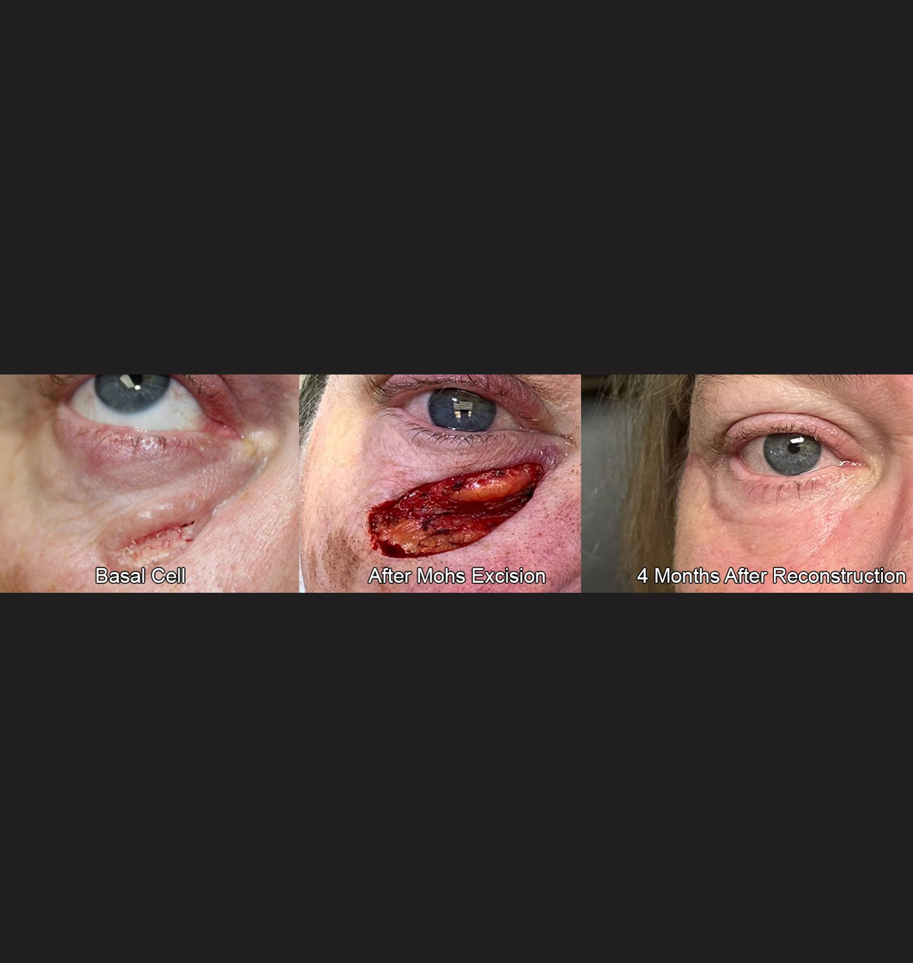 Eyelid Reconstruction After Skin Cancer