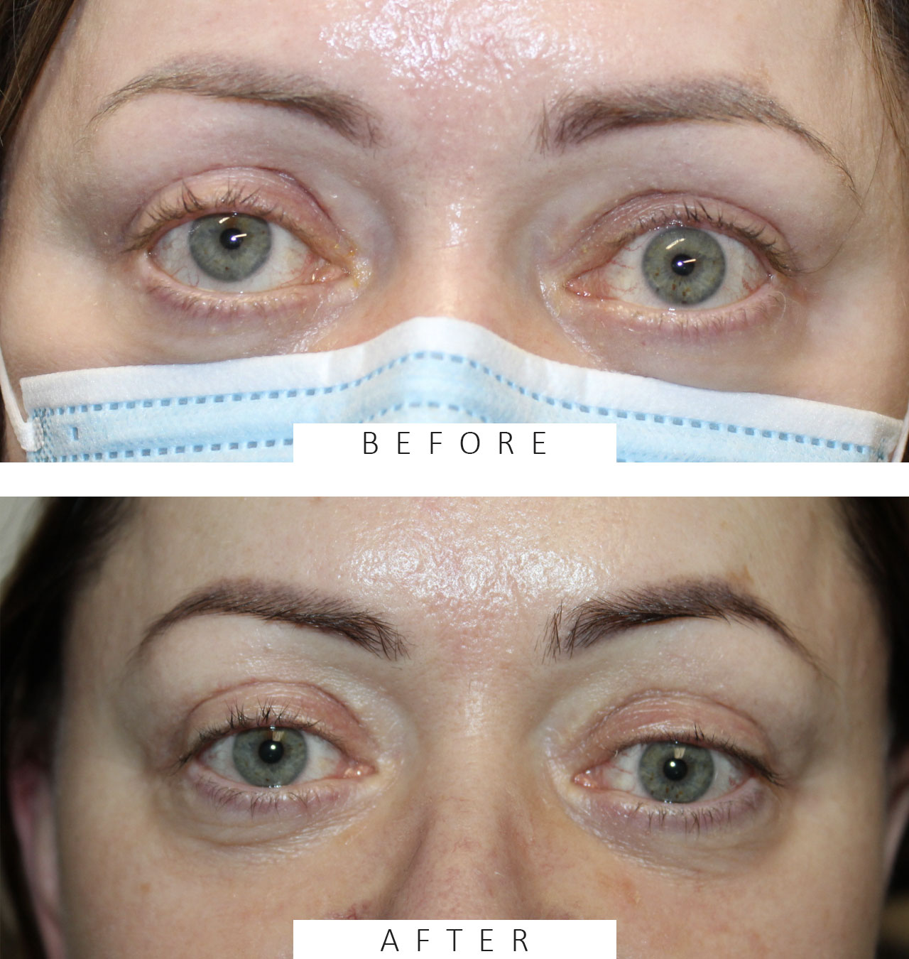 Left Upper Eyelid Retraction Repair