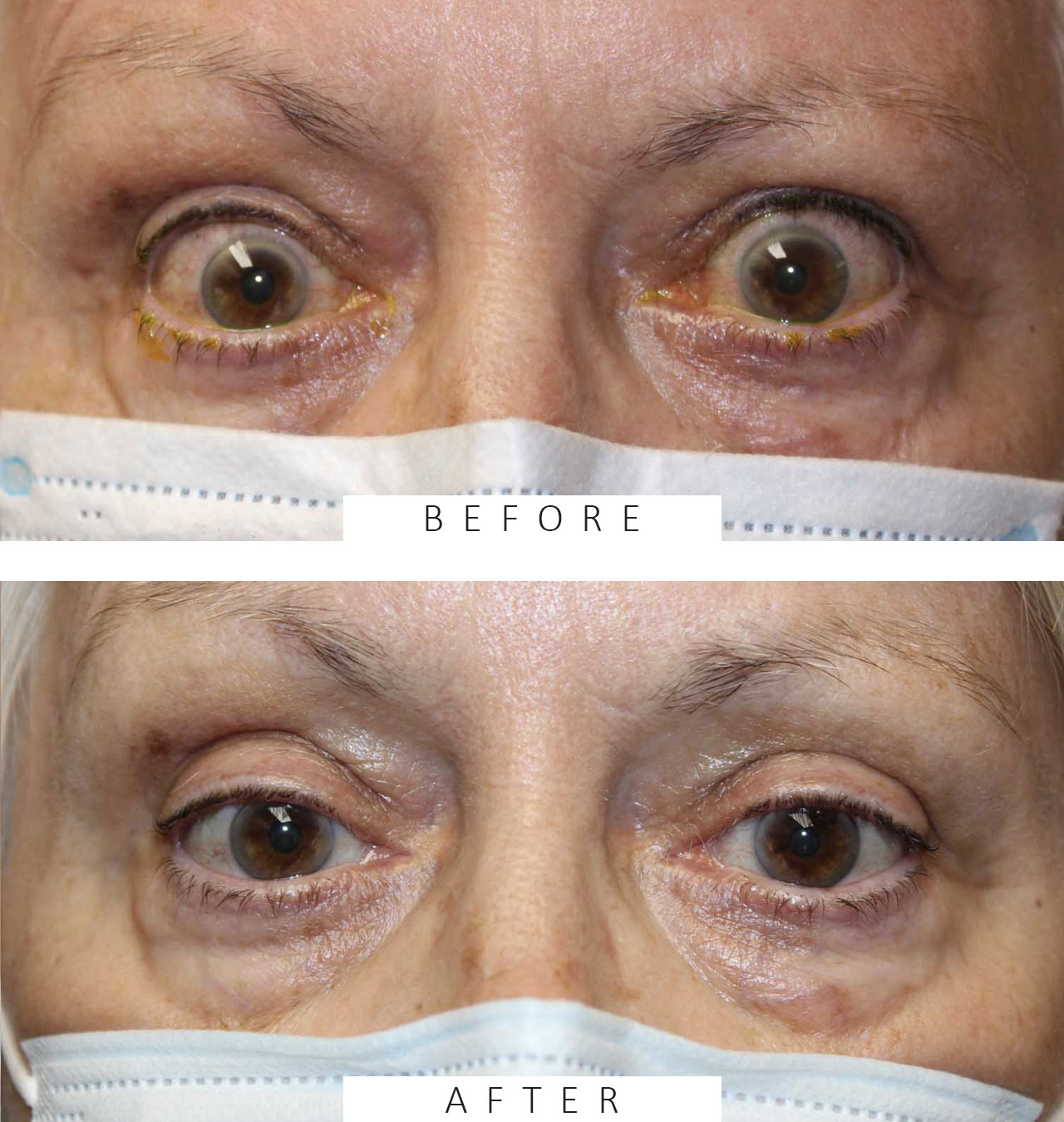 Upper Eyelid Retraction Repair for Thyroid Eye Disease