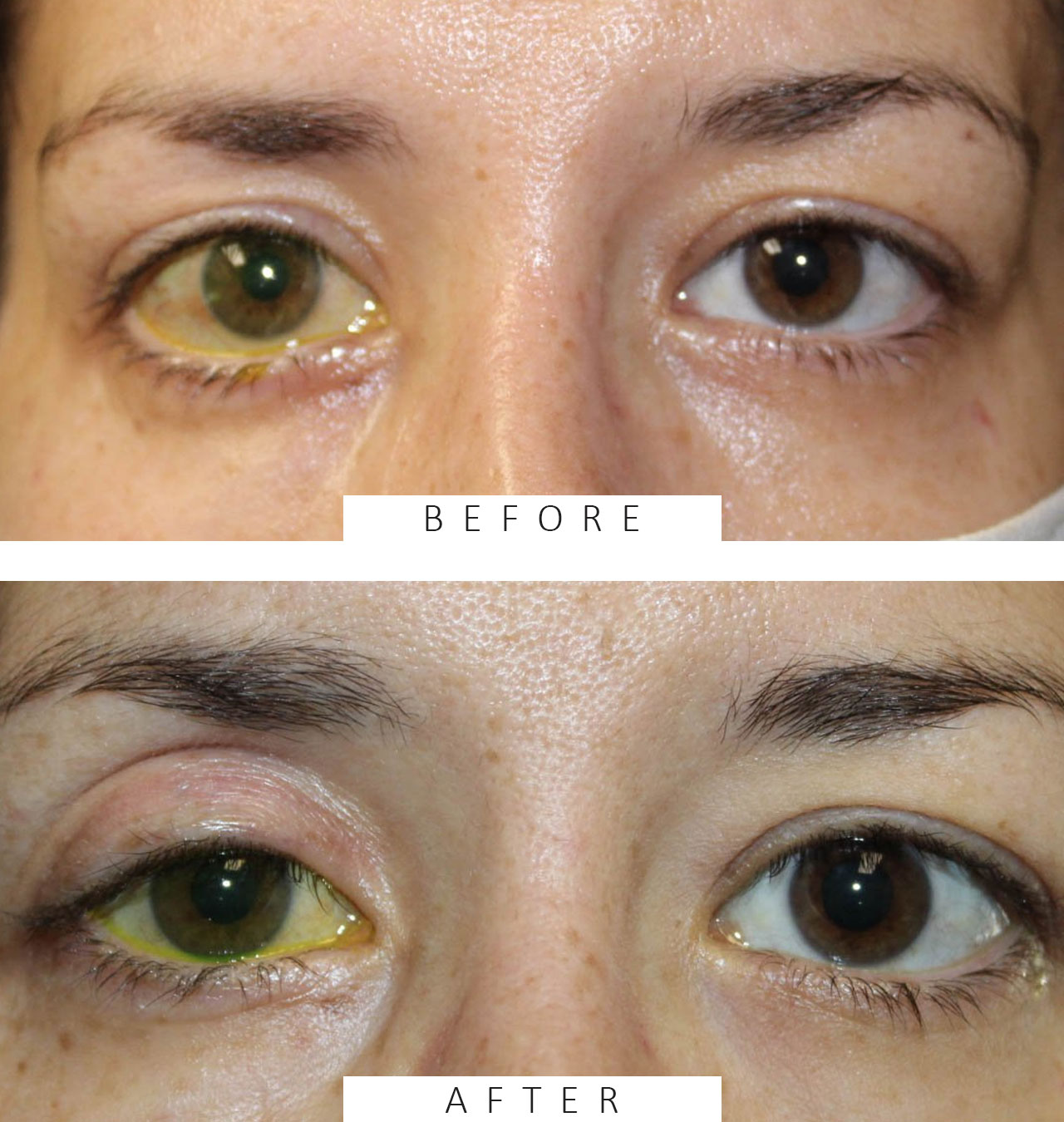 Placement of Gold Weight and Lateral Tarsorrhaphy for Paralysis of Eyelid Closure