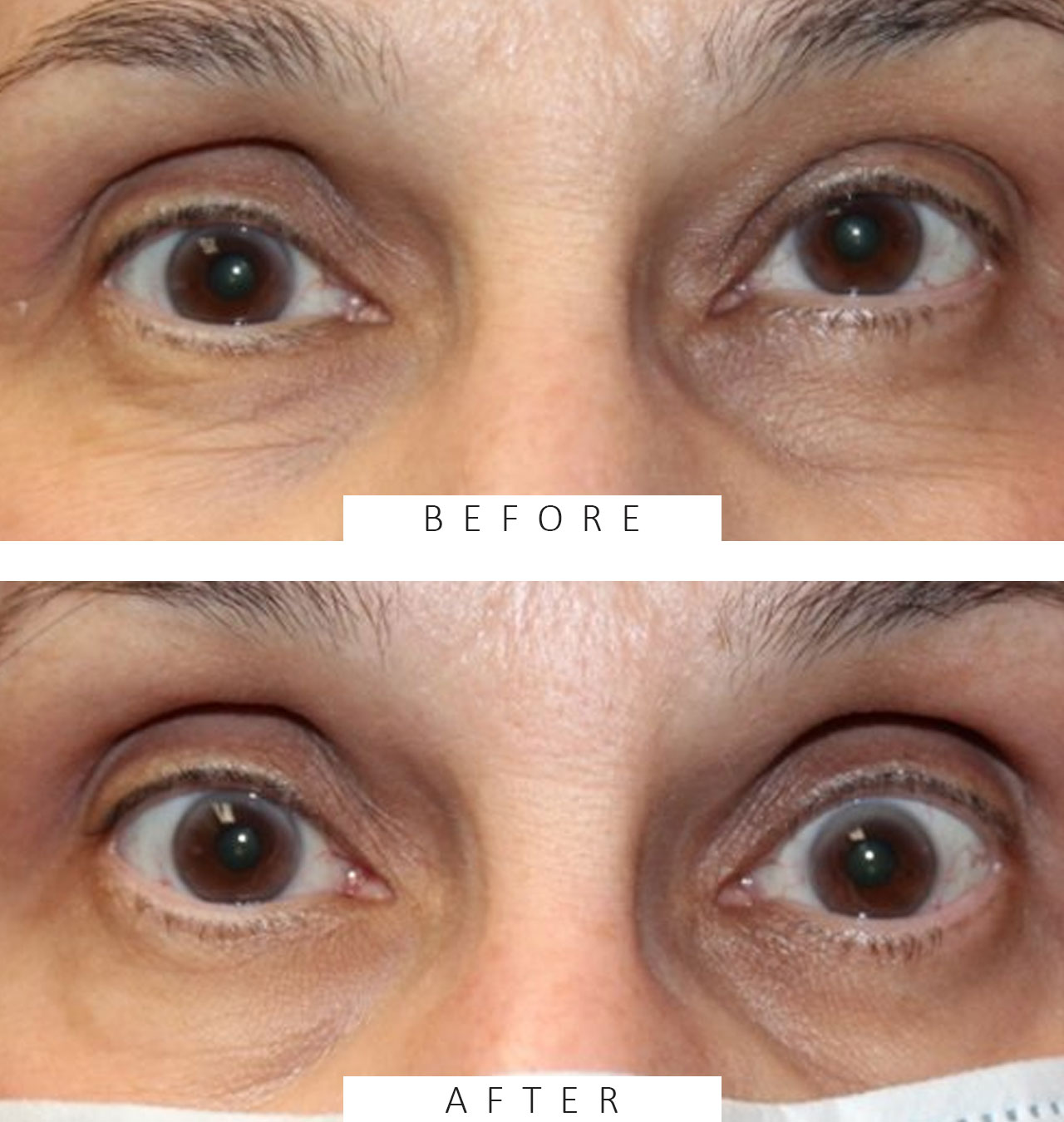 Orbital Tumor Located Underneath the Eye