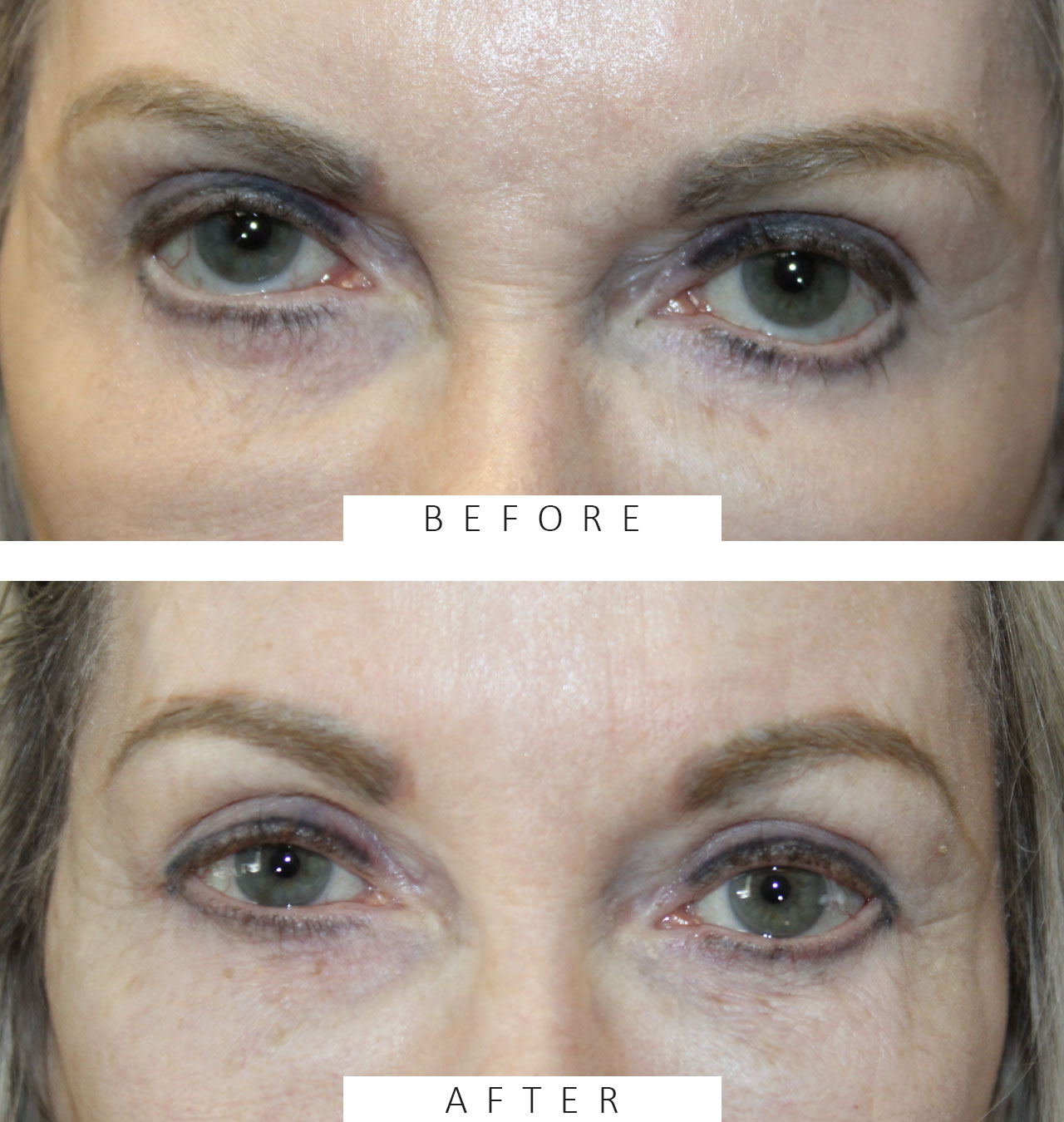 Correction of post-surgical lower eyelid retraction