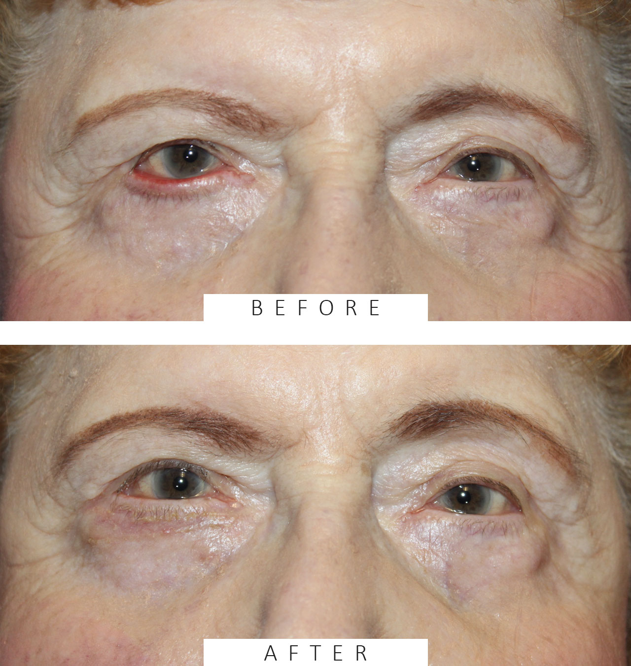 Ectropion Repair using a Tripier Flap
