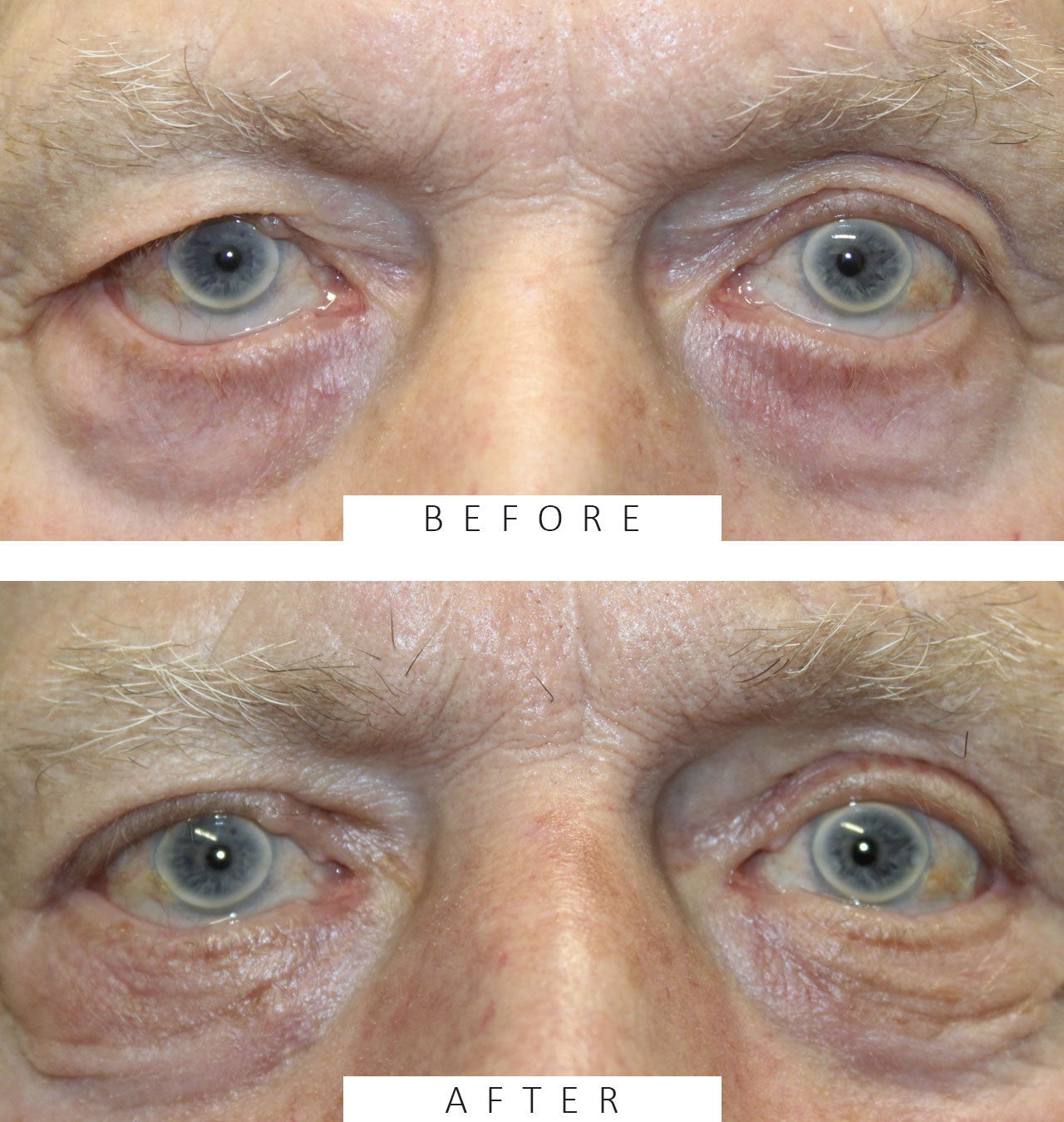 Lower Eyelid Retraction and Ectropion Repaired via Tripier Flap
