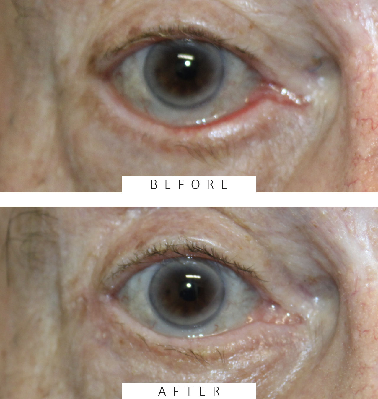 Ectropion with Skin Graft