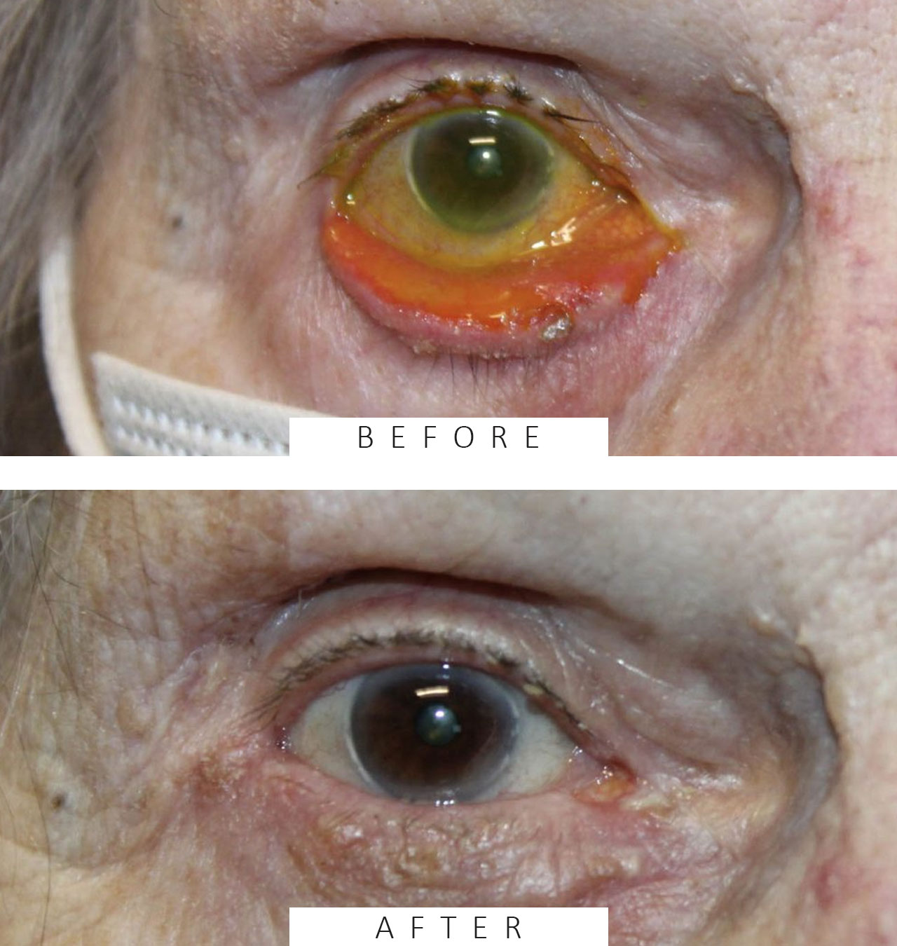 Ectropion Repair with use of Skin Graft