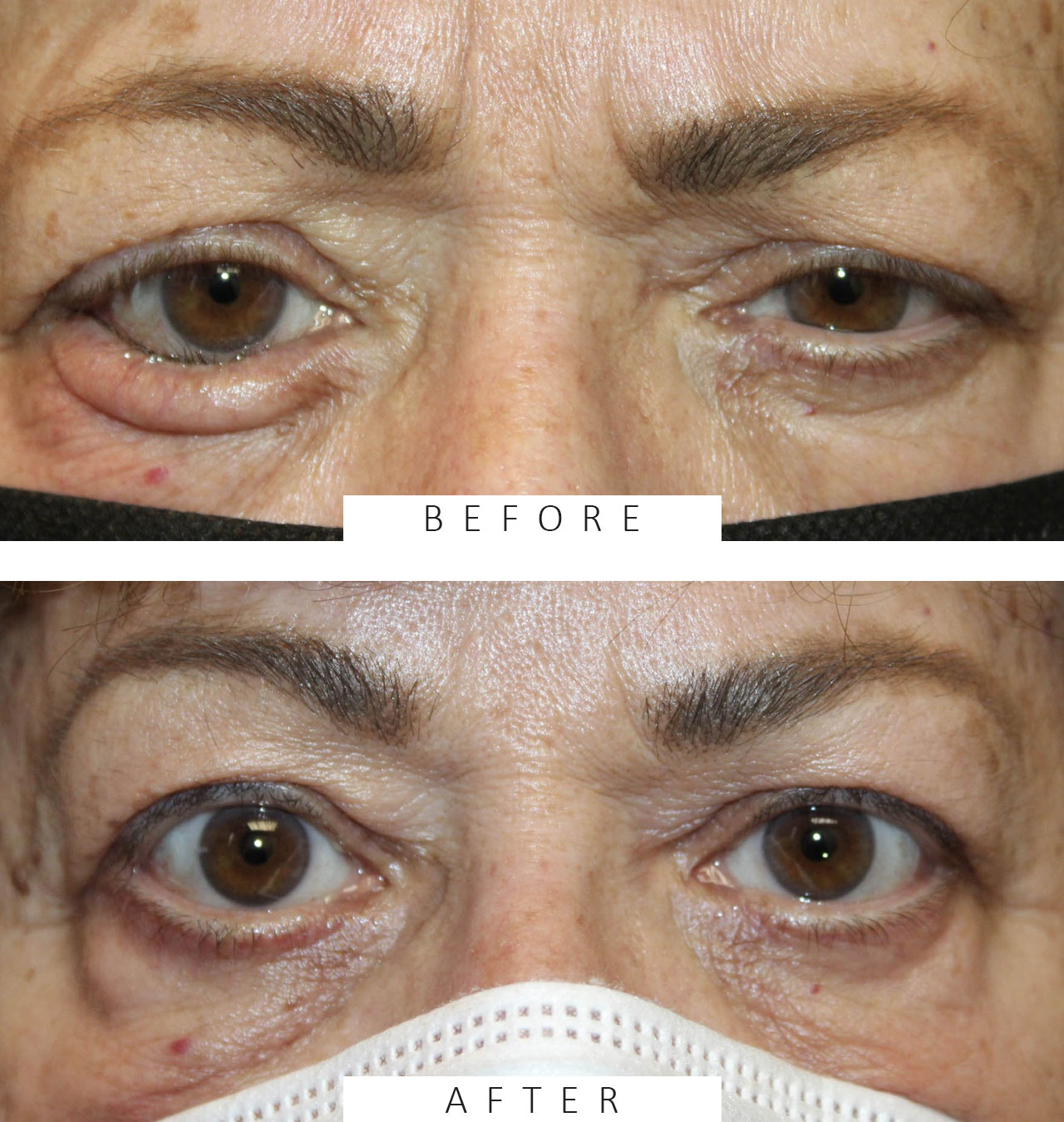 Right Lower Eyelid Entropion Repair