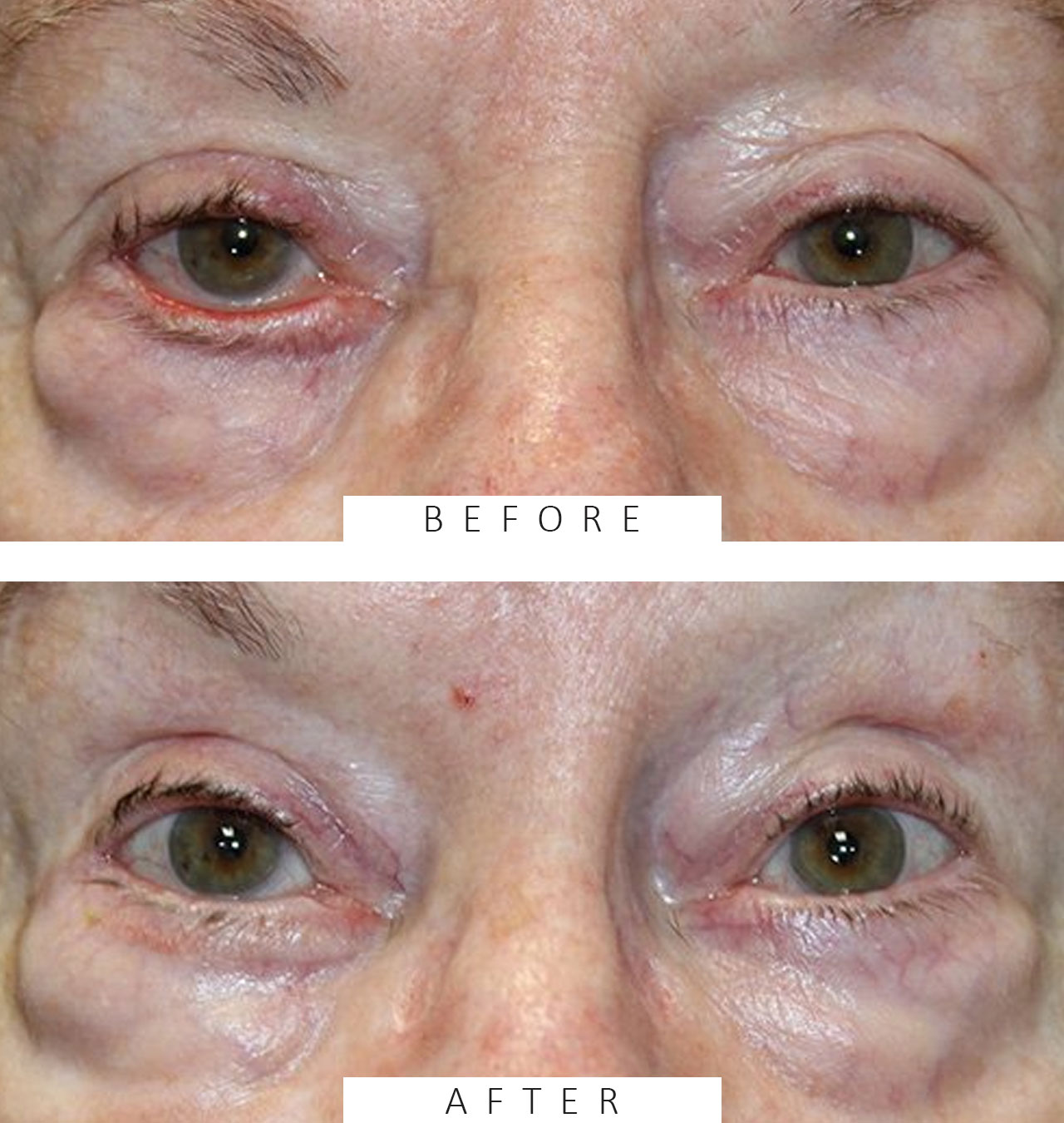 Ectropion Repair using a Skin Graft