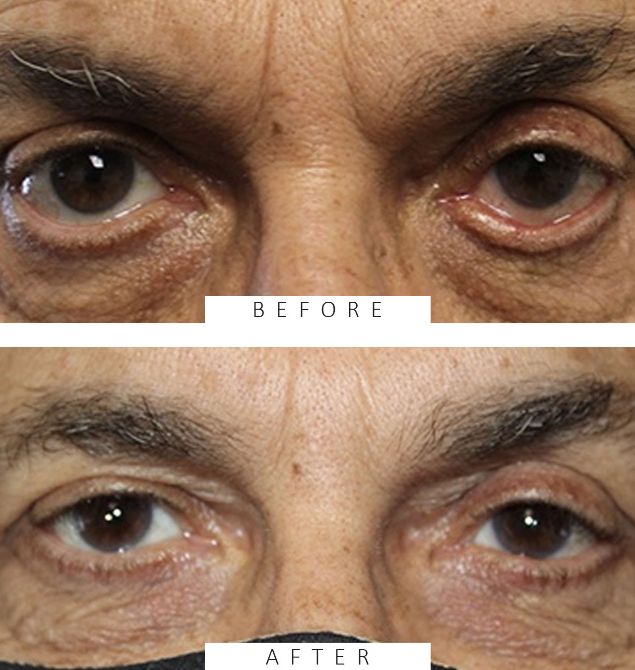 Ectropion Repair