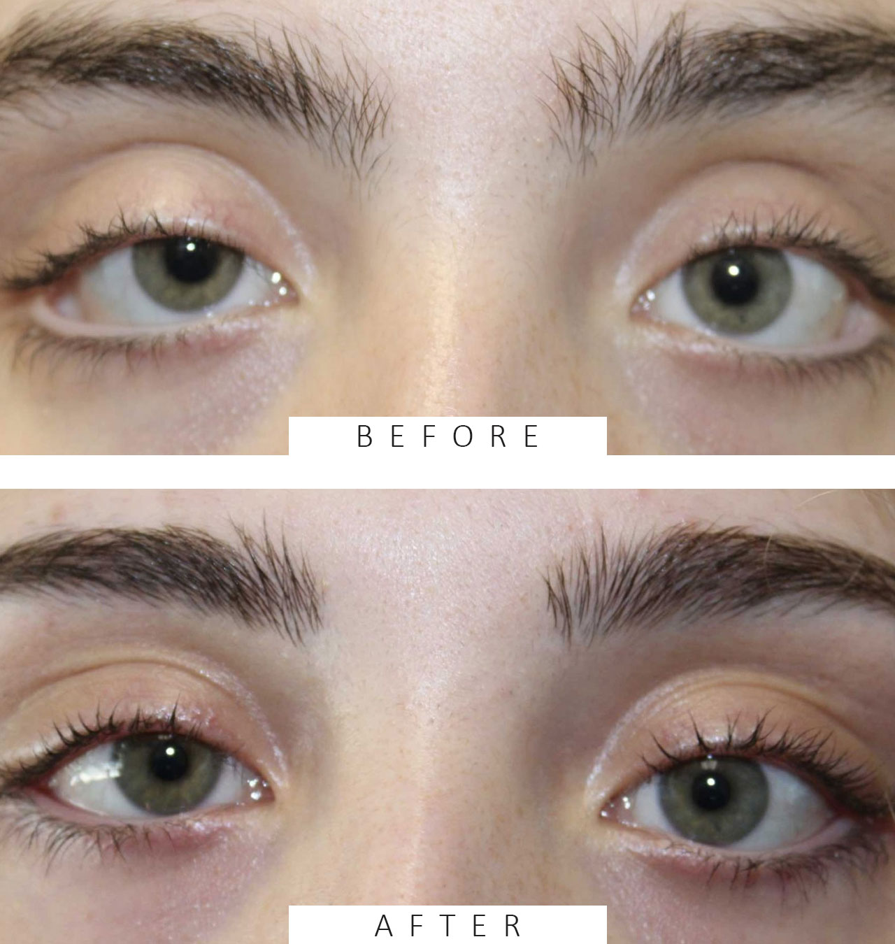 Ectropion Repair & Mini-Facelift