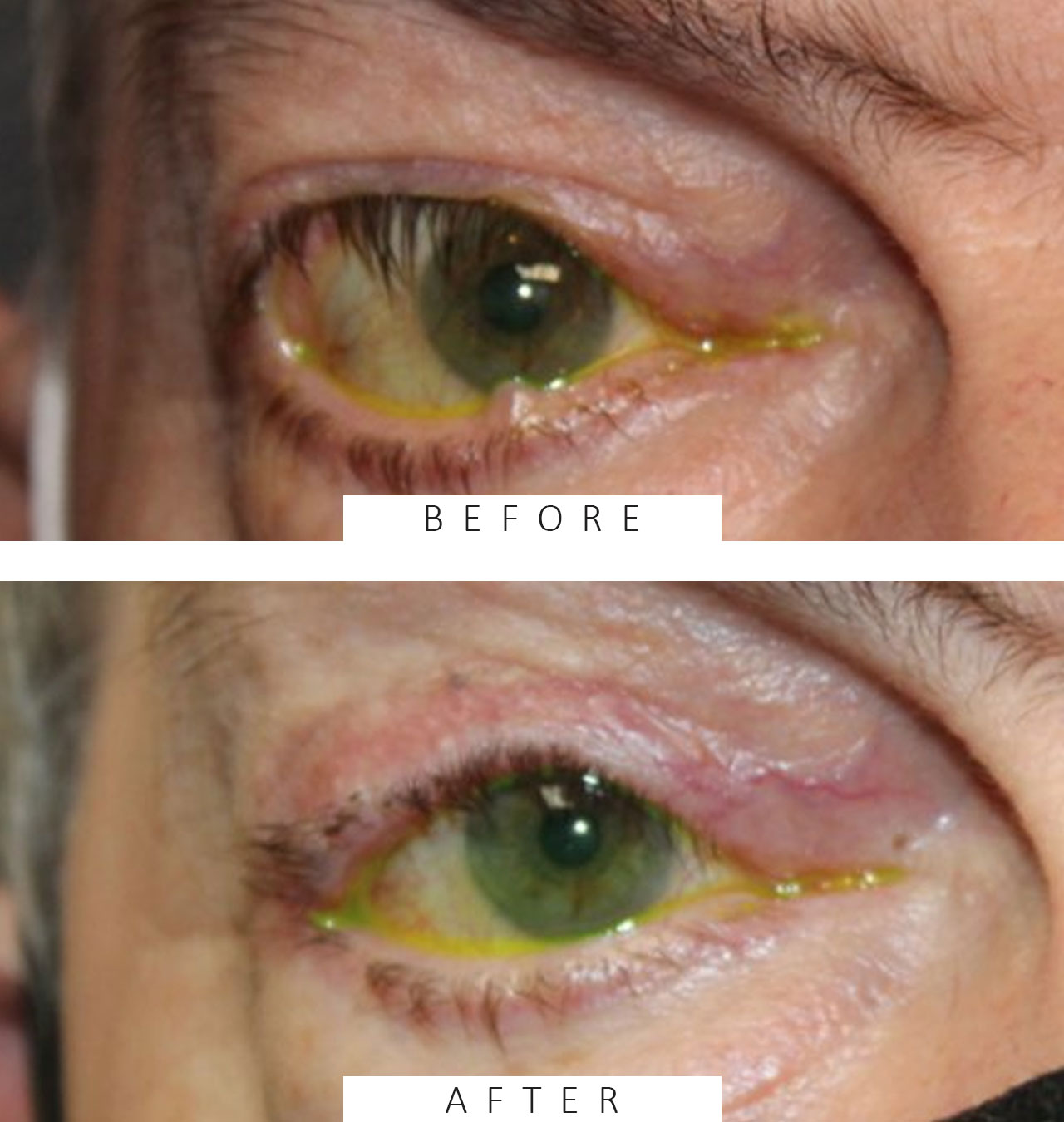 Cicatricial Entropion and Eyelid Retraction Repair