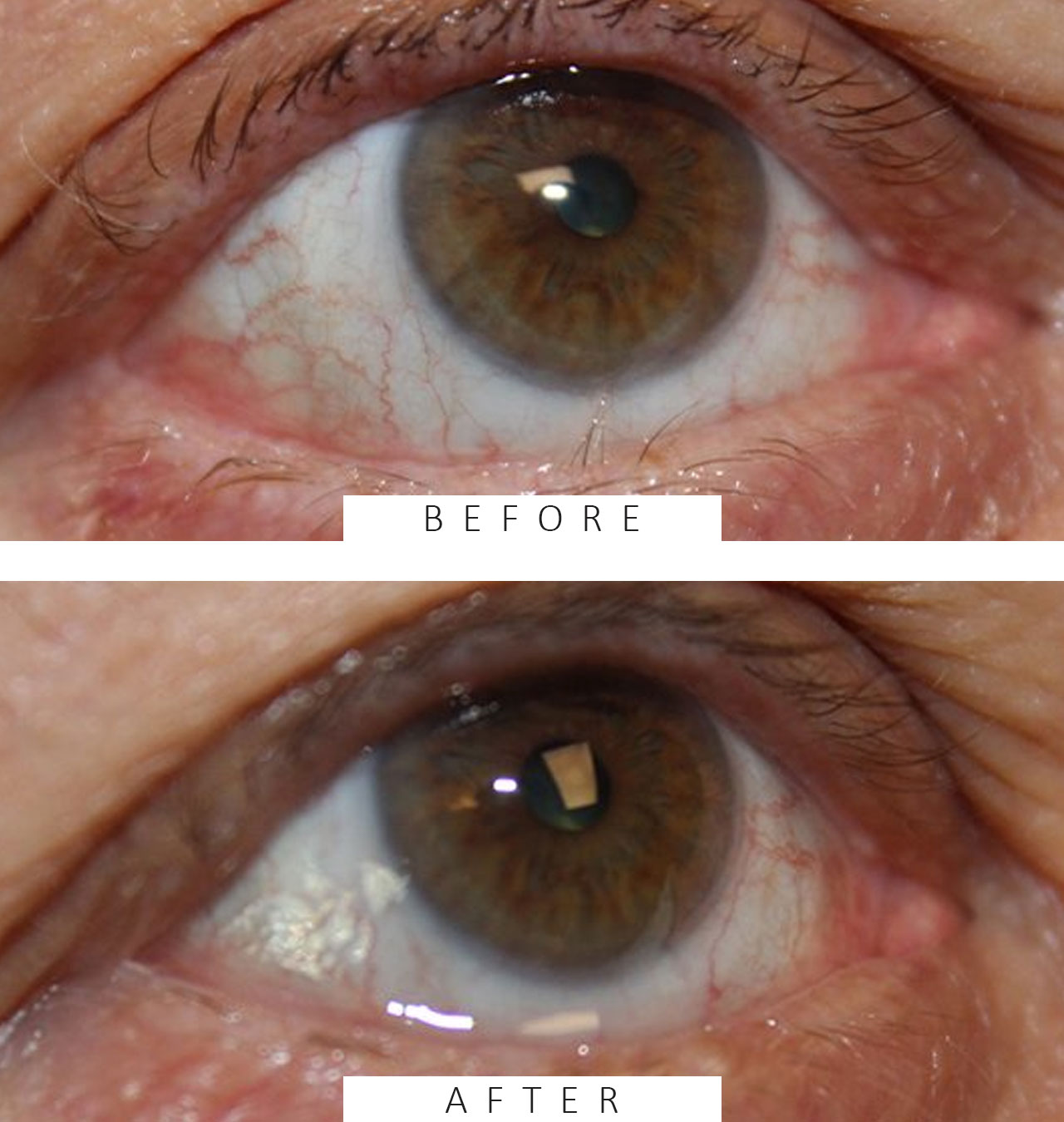 Trichiasis Repair by Electrohyfrecation