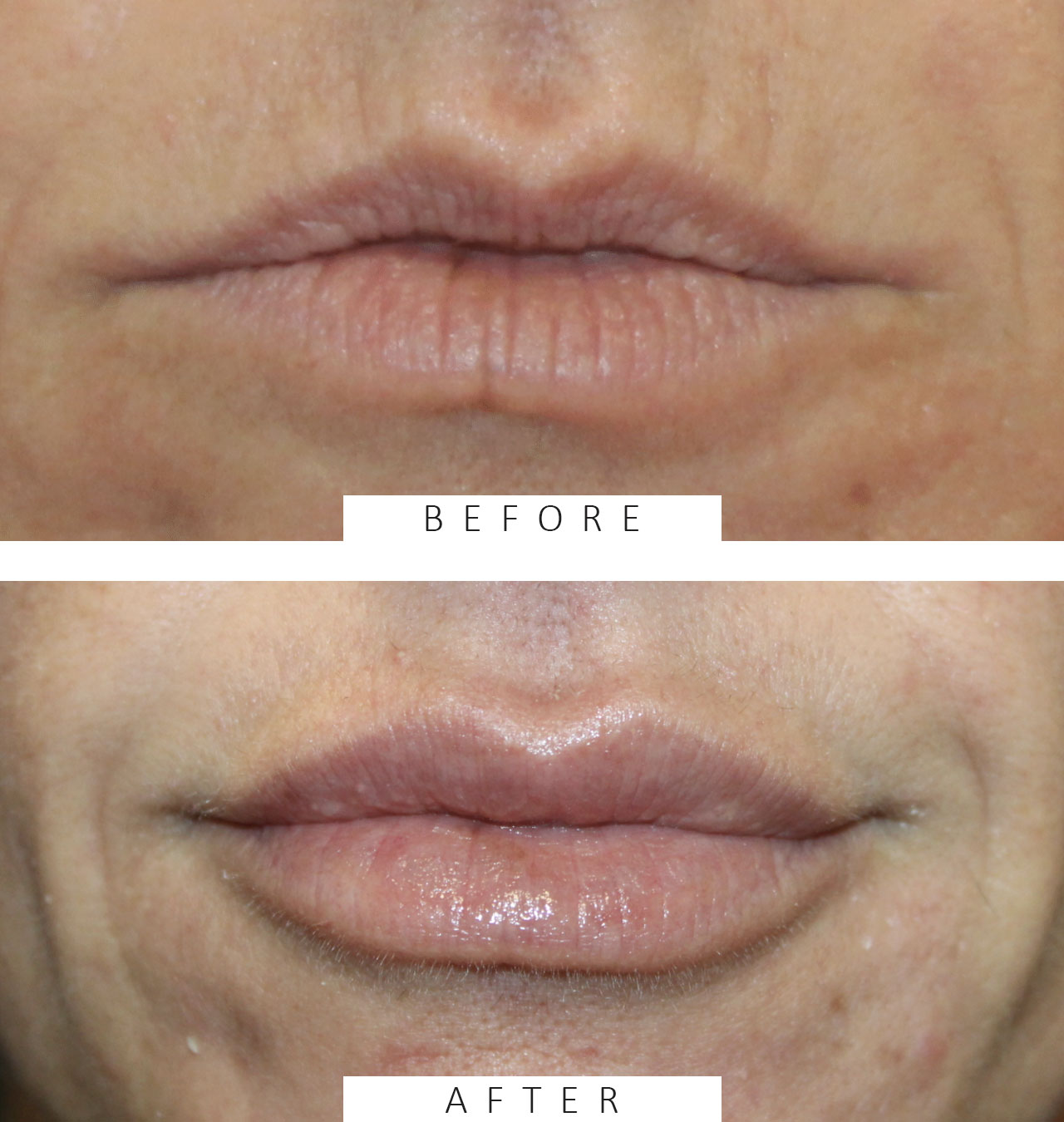 Lip Filler Treatment
