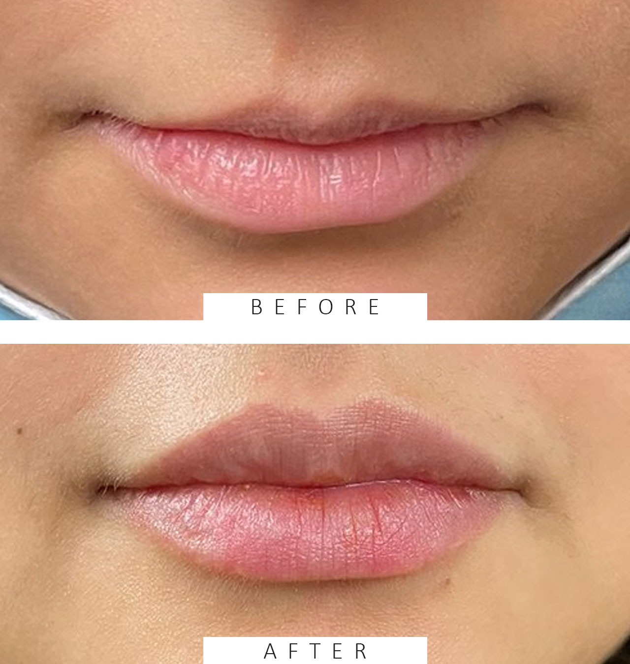 Lip Filler Treatment