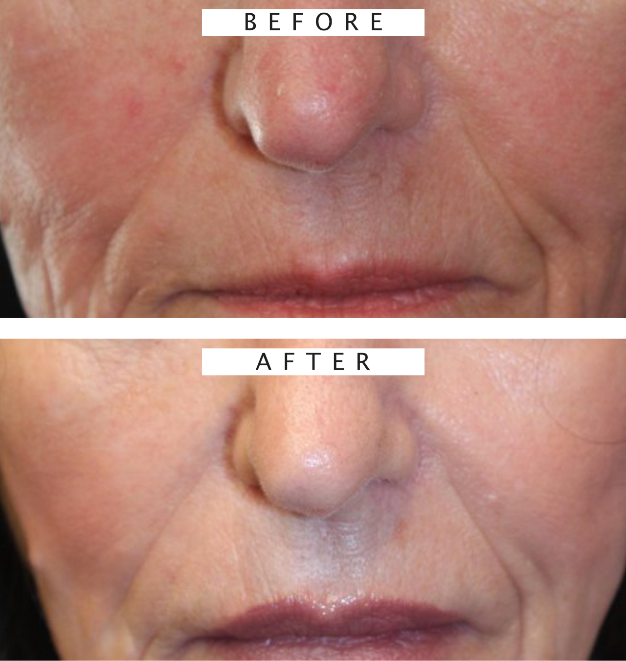 Botox Treatment