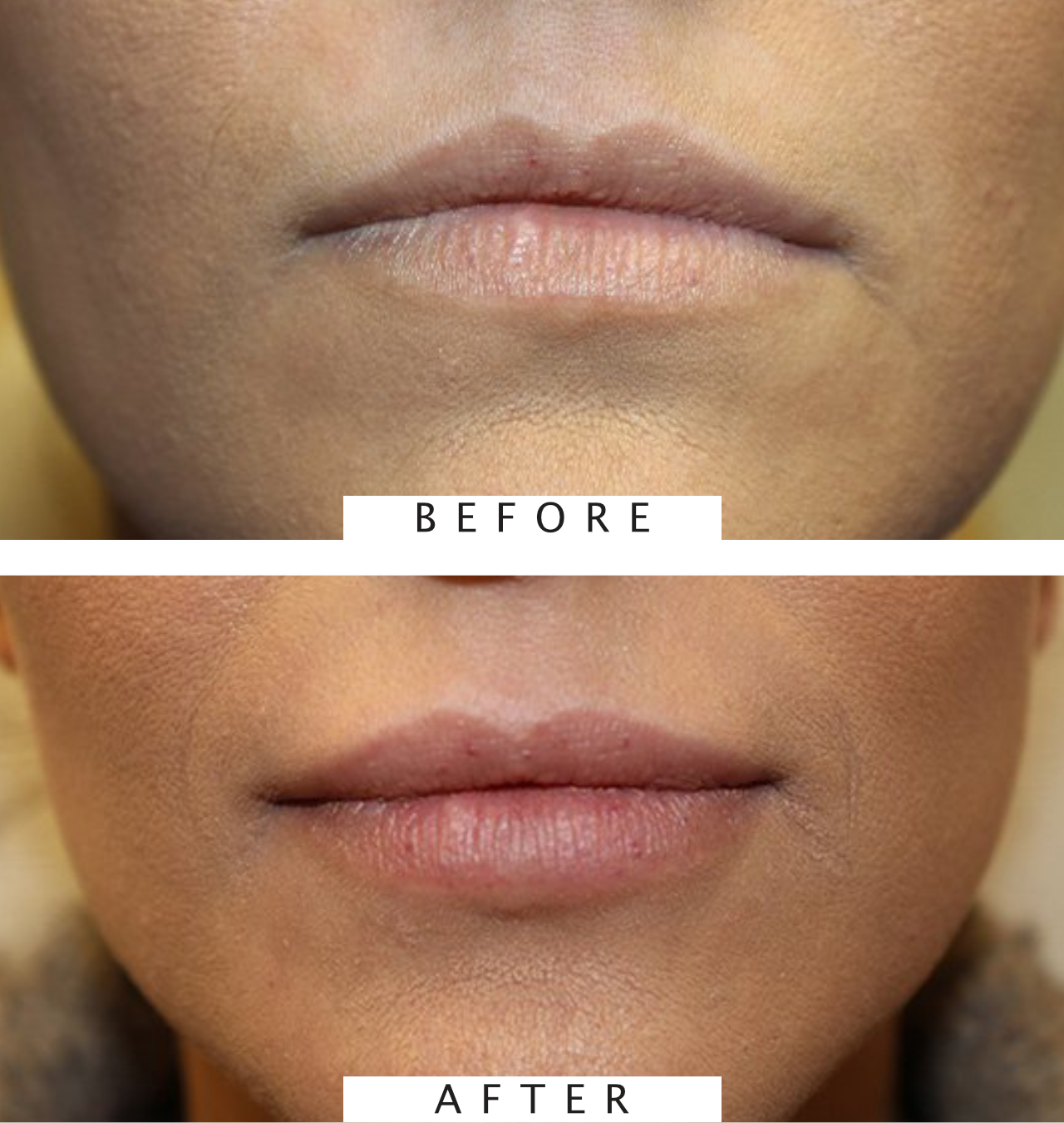 Juvéderm Treatment to plump lips