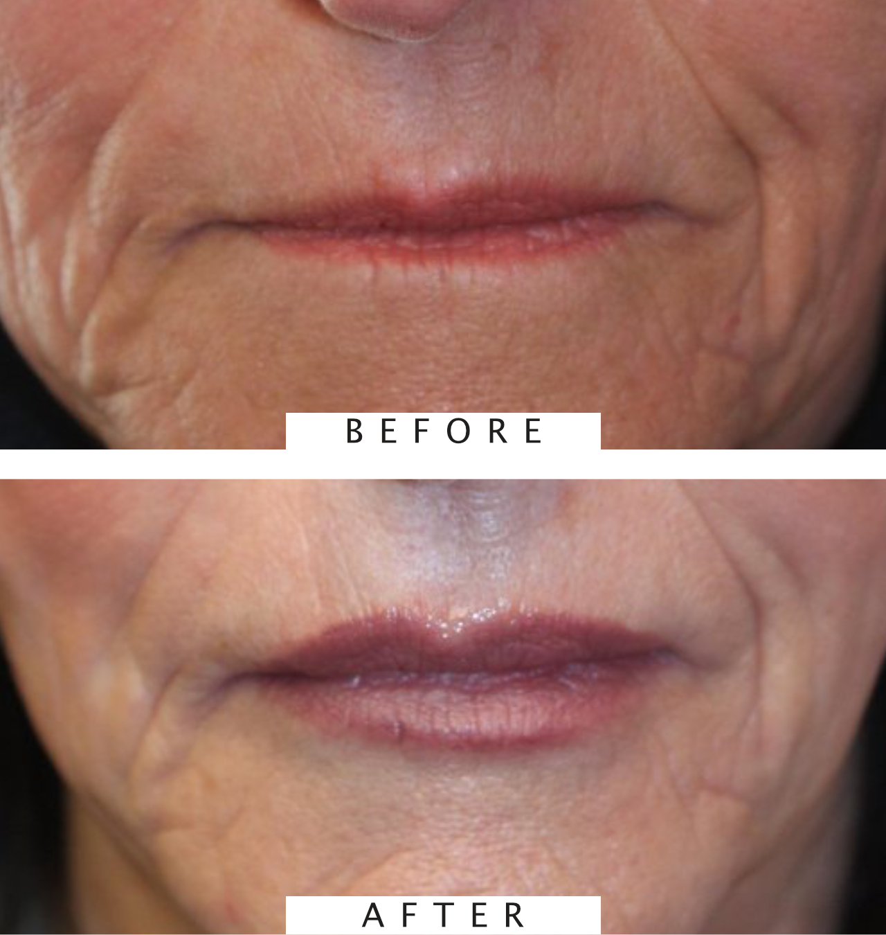 Restylane Treatment