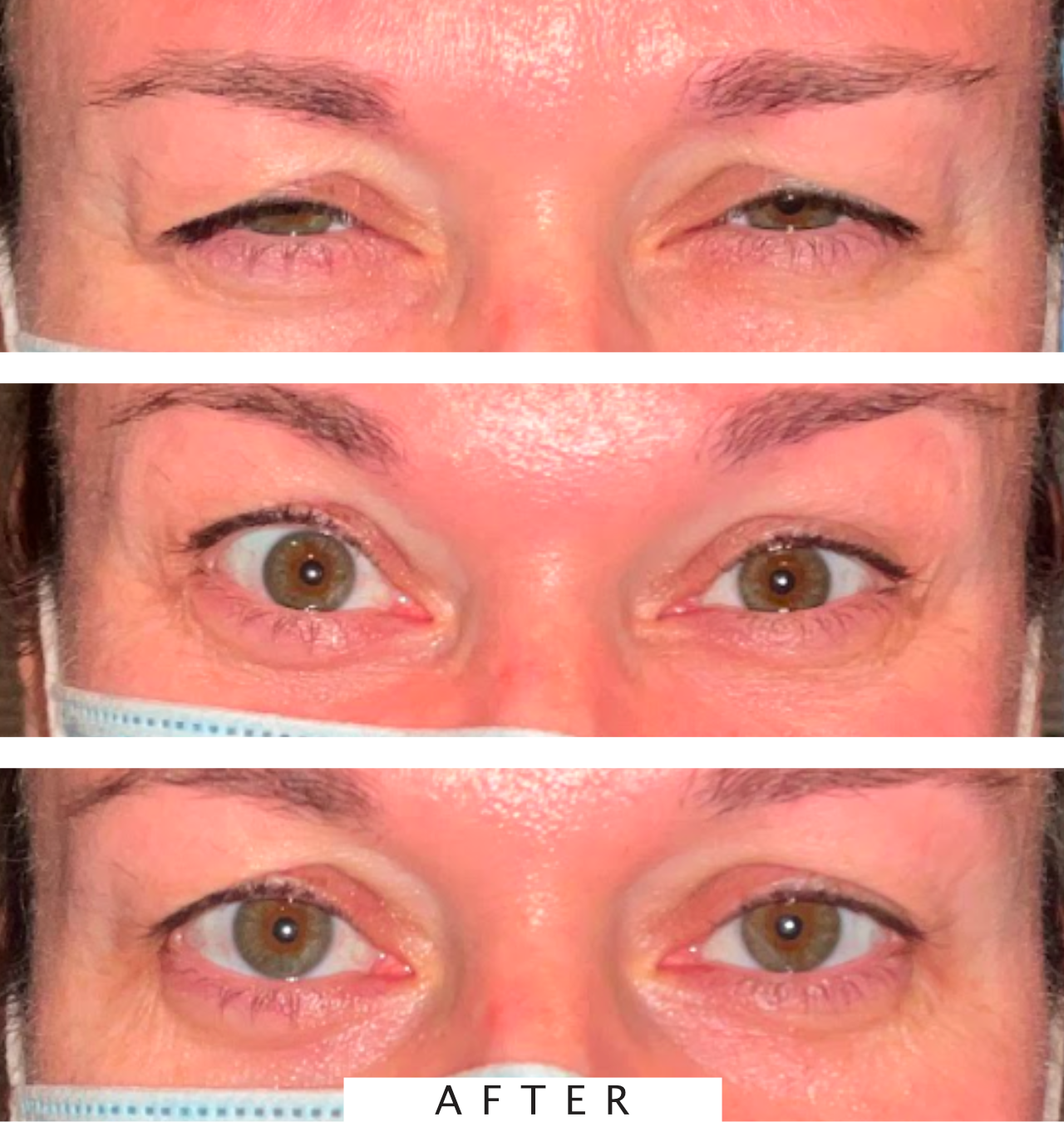 Botox Treatment
