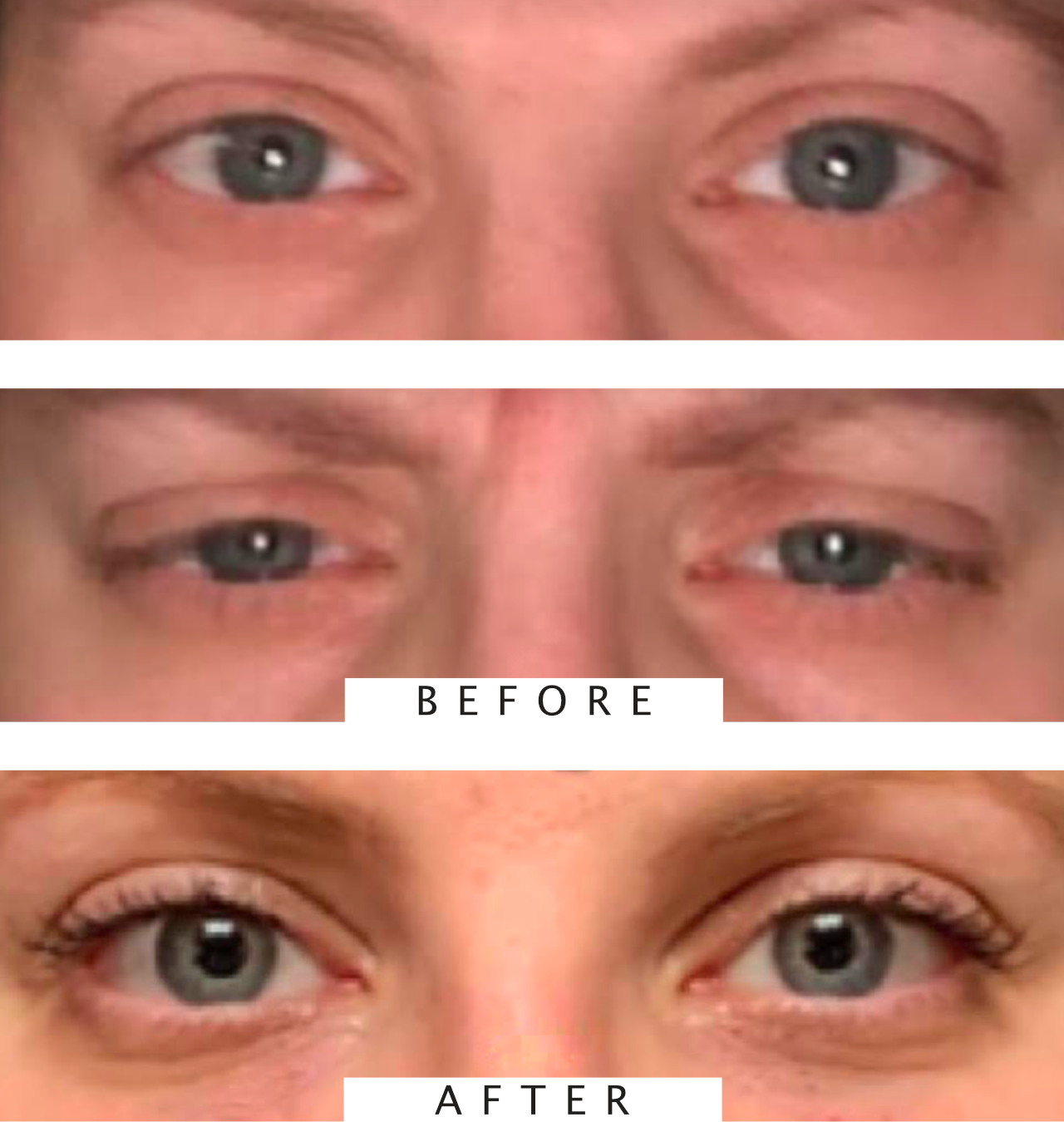 Under Eye Filler