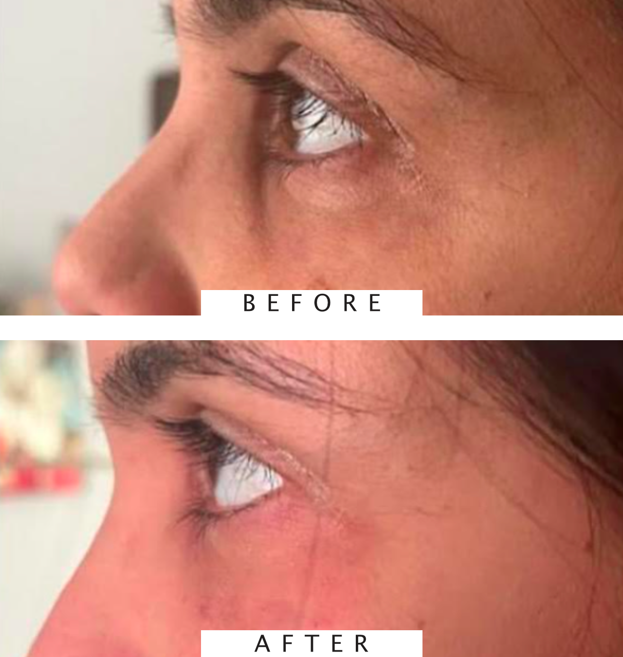 Under Eye Filler