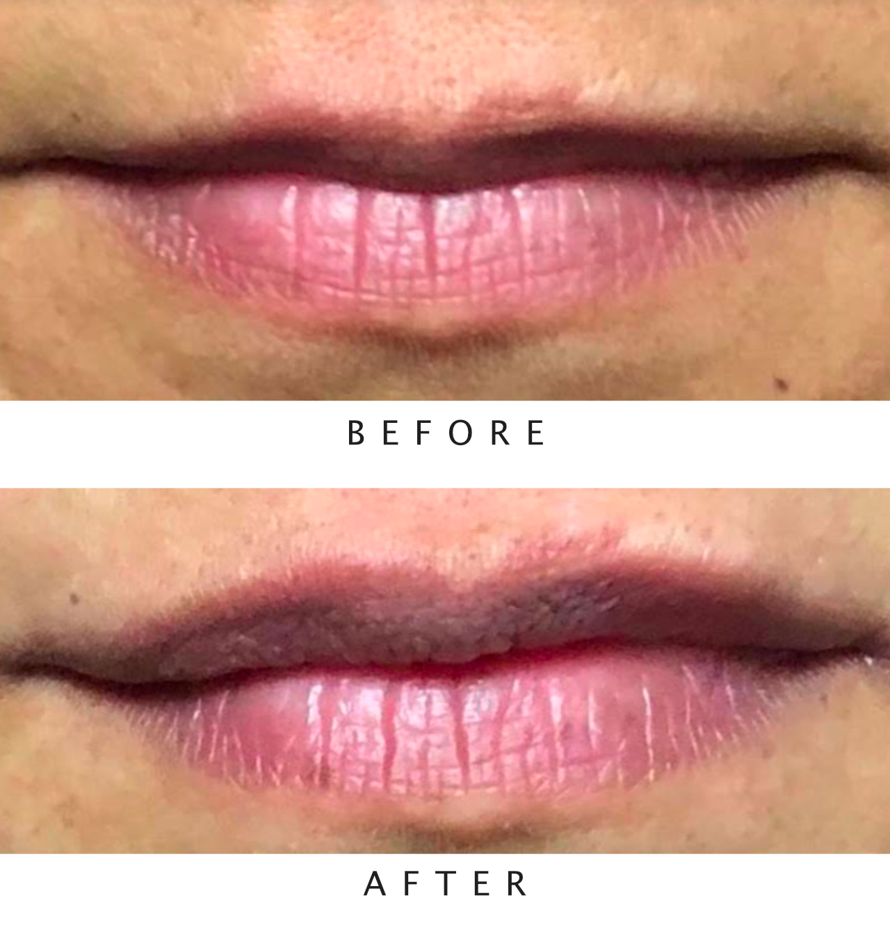 Lip Filler Treatment