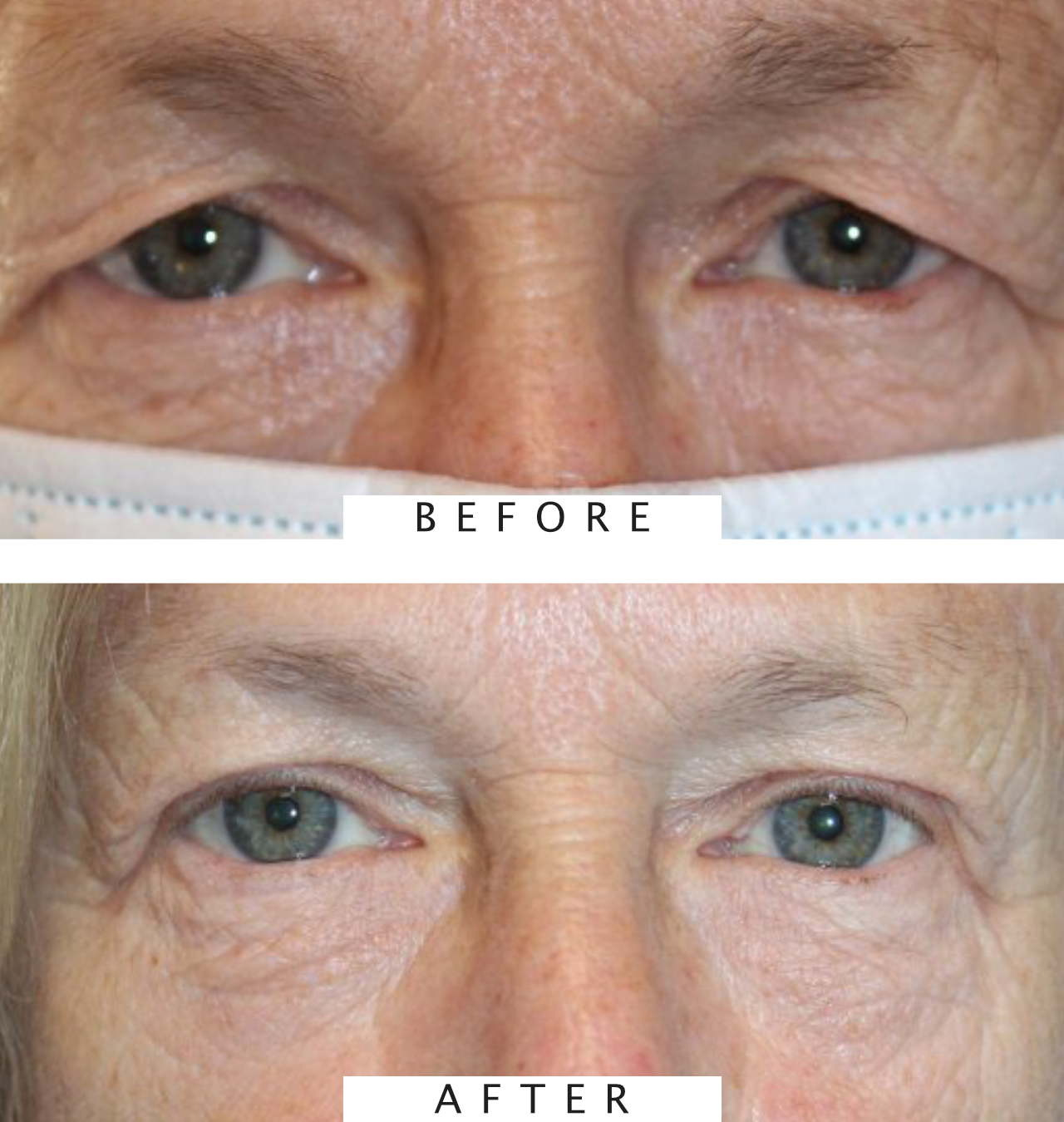 Upper Blepharoplasty and Brow Lift