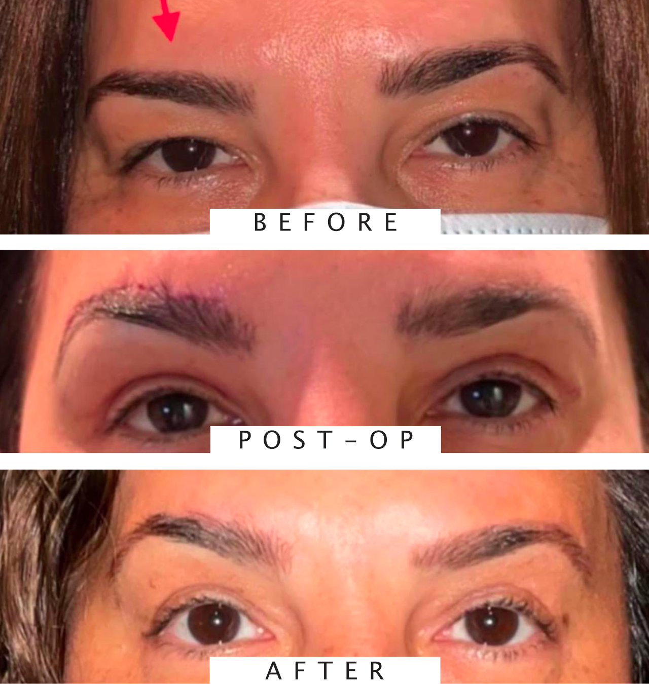 Brow Lift