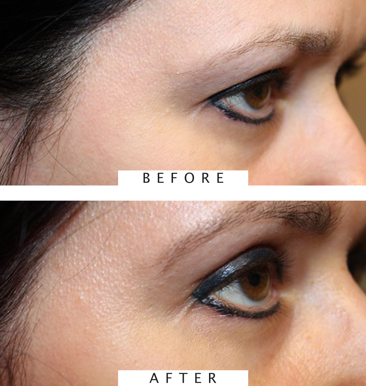 Brow Lift to Refresh Look