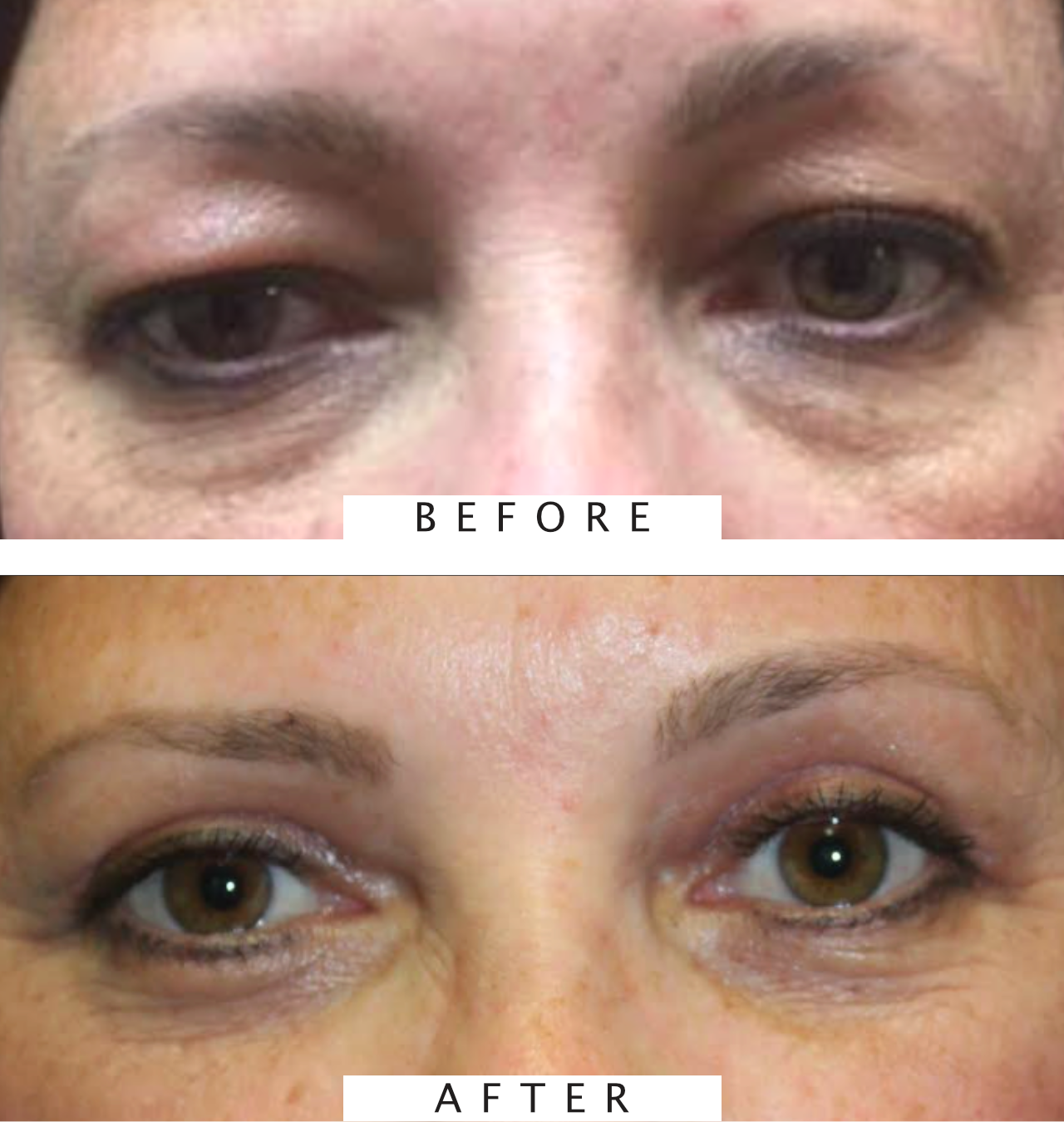 Cosmetic Upper/Lower Blepharoplasty with Botox to Glabella, Crow's Feet, and Forehead