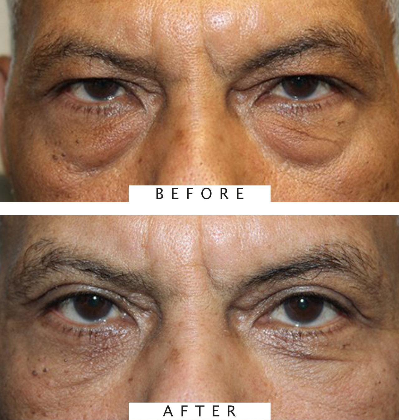 Upper & Lower Blepharoplasty