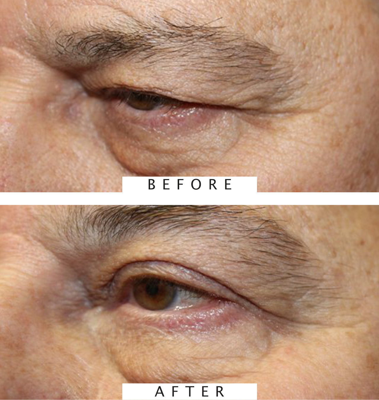 Blepharoplasty to Repair Tired Eyes