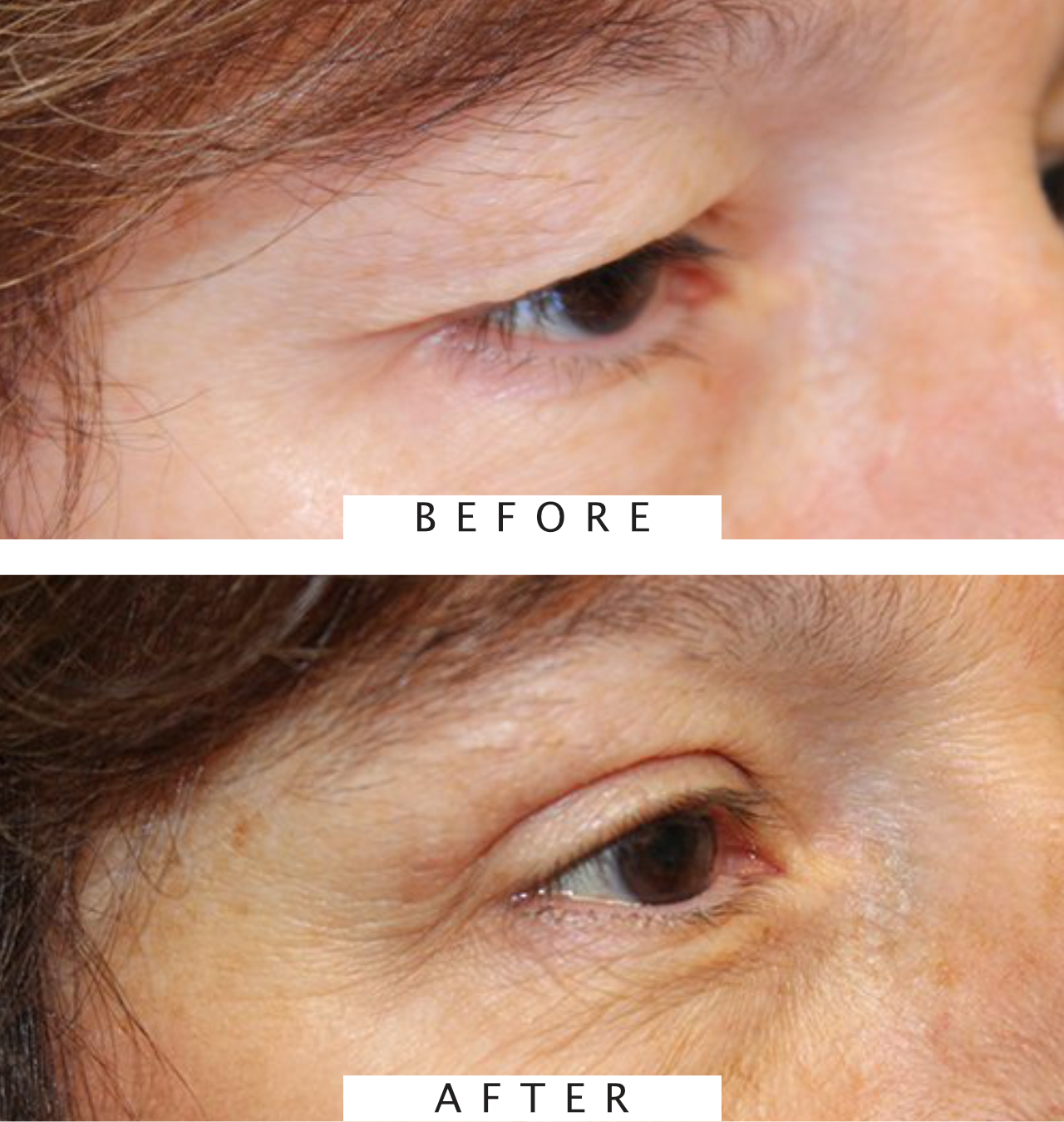 Upper Blepharoplasty