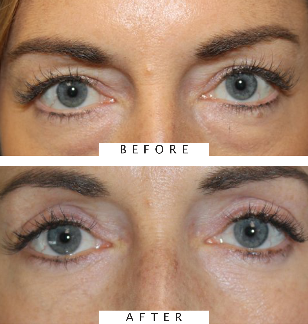 Upper & Lower Blepharoplasty