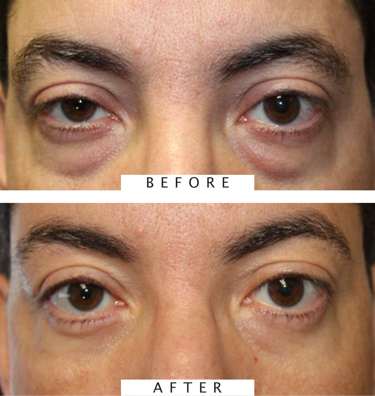 Lower Blepharoplasty