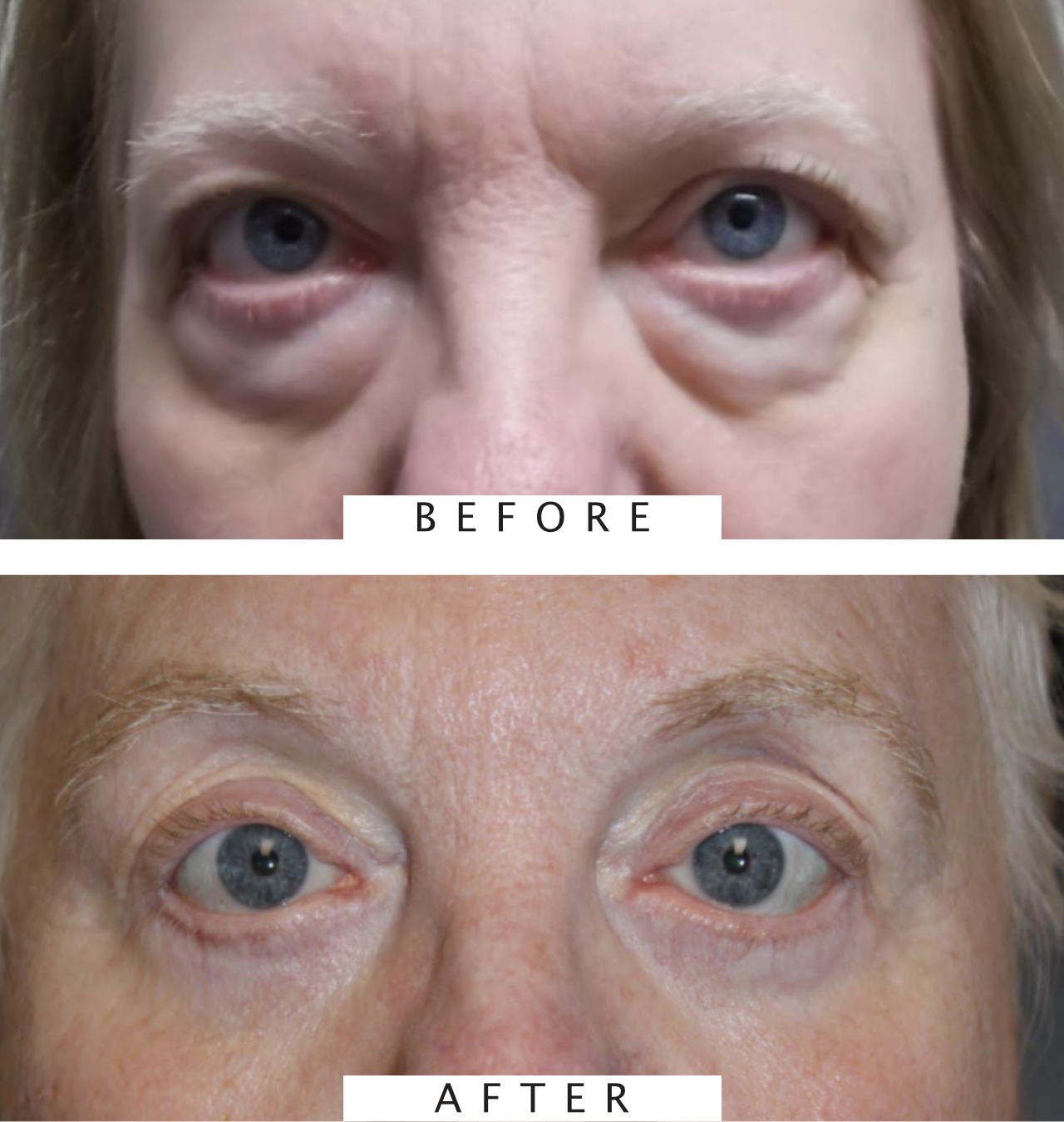 Cosmetic Upper and Lower Blepharoplasty Bilateral Canthoplasty Botox & Obagi Chemical Peels CO2 Laser Resurfacing to Full Face