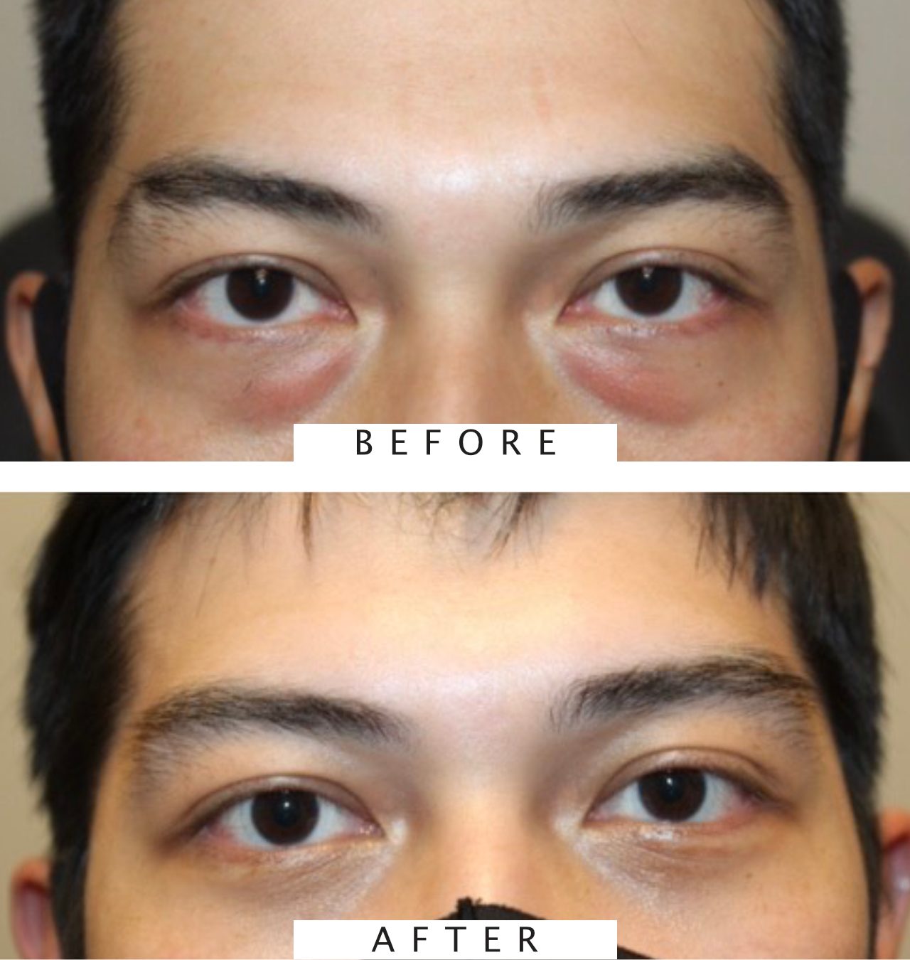 Cosmetic Lower Blepharoplasty
